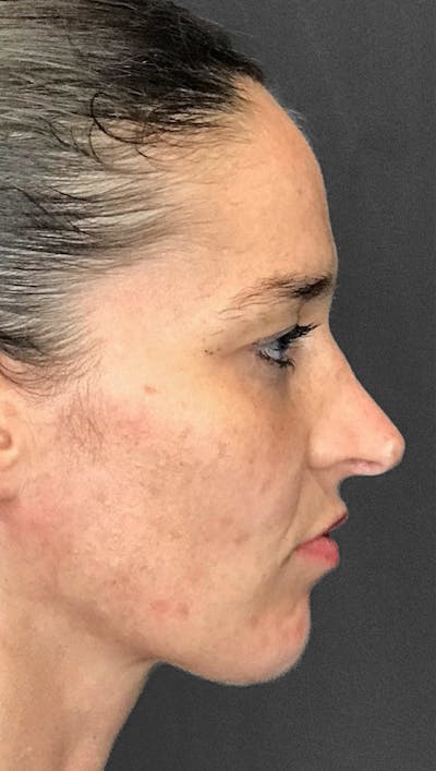 Non-Surgical Rhinoplasty Before & After Gallery - Patient 151452163 - Image 2
