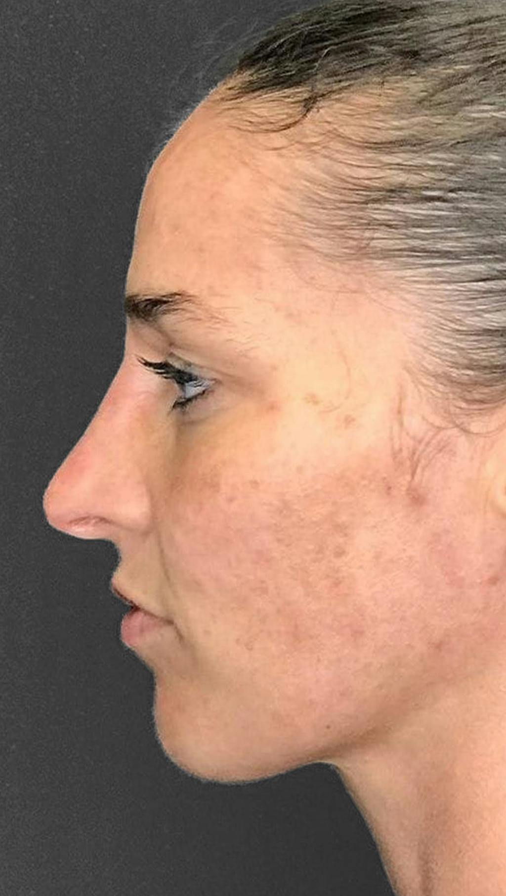 Non-Surgical Rhinoplasty Before & After Gallery - Patient 151452163 - Image 5