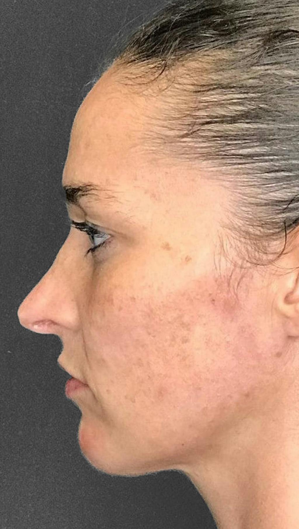 Non-Surgical Rhinoplasty Before & After Gallery - Patient 151452163 - Image 6