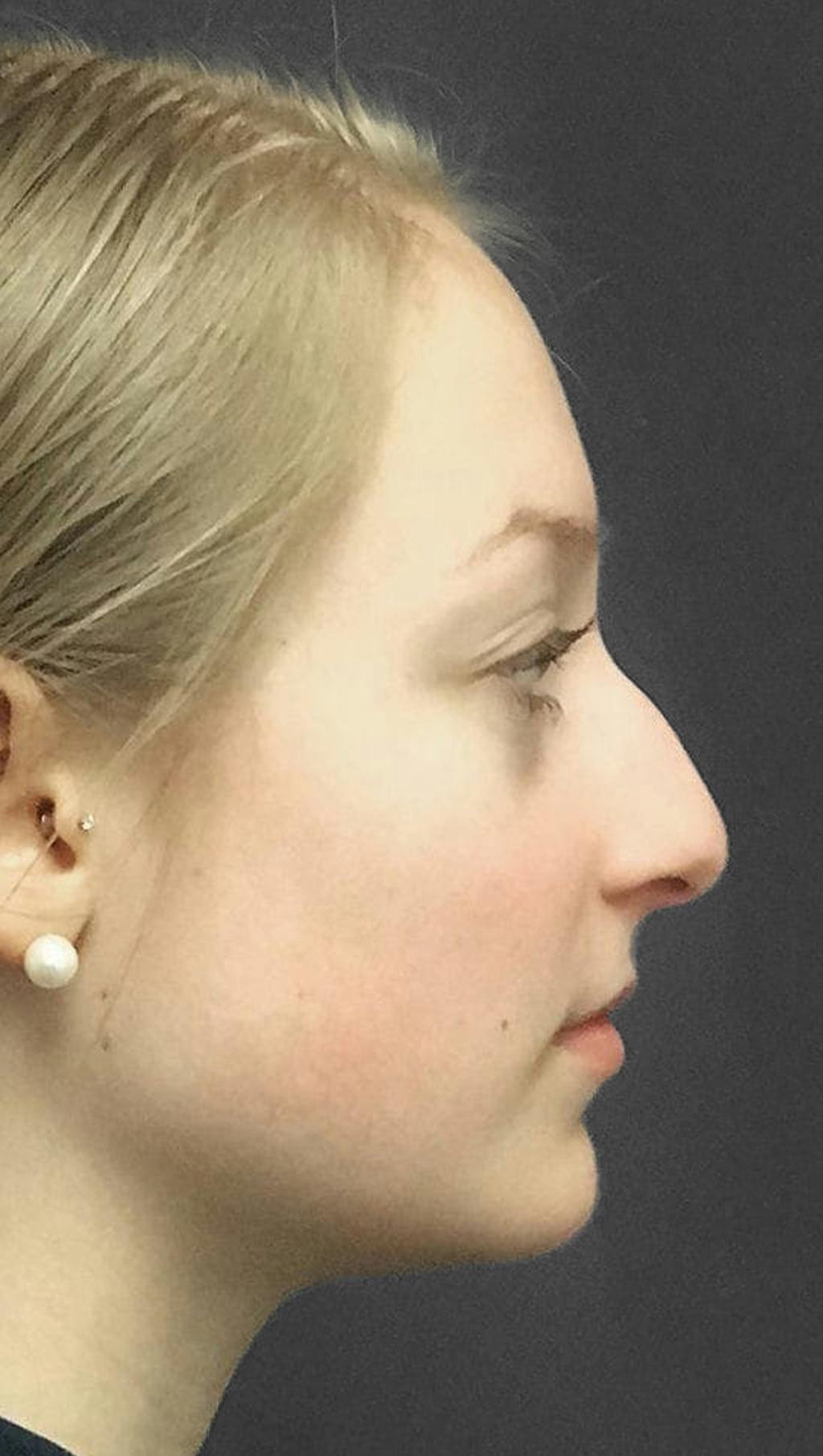 Non-Surgical Rhinoplasty Before & After Gallery - Patient 151452165 - Image 1