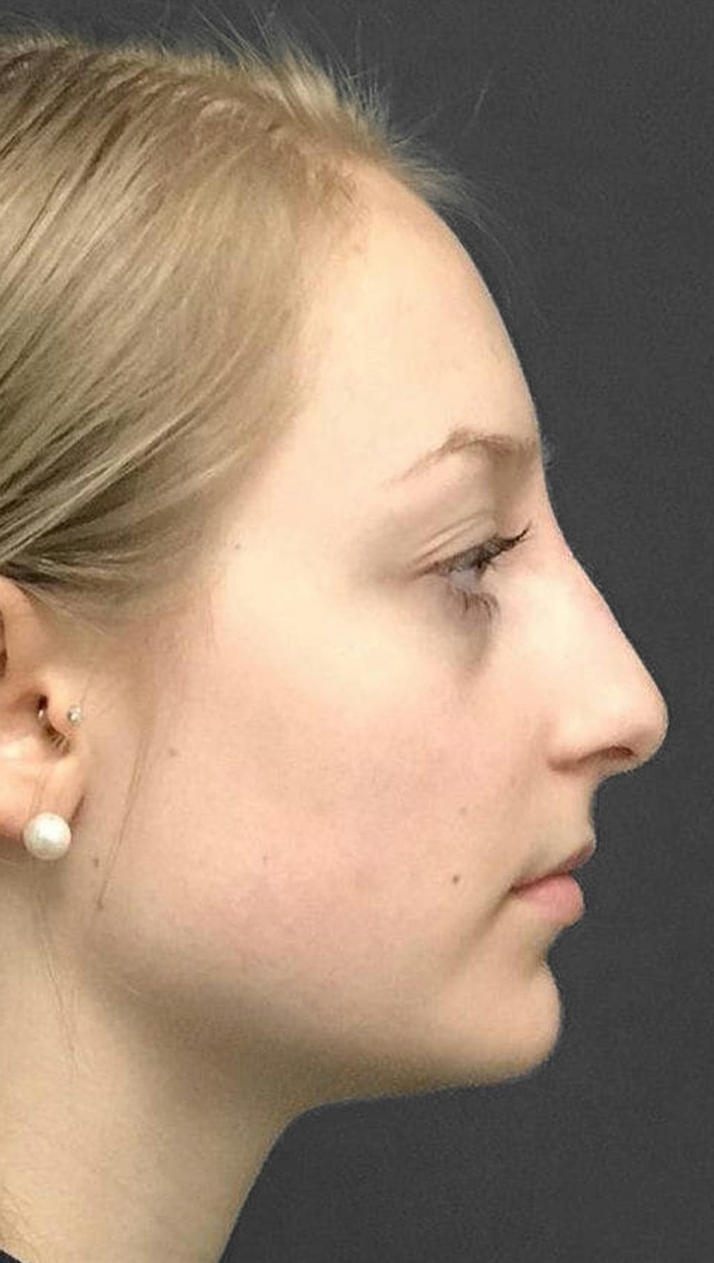 Non-Surgical Rhinoplasty Before & After Gallery - Patient 151452165 - Image 2