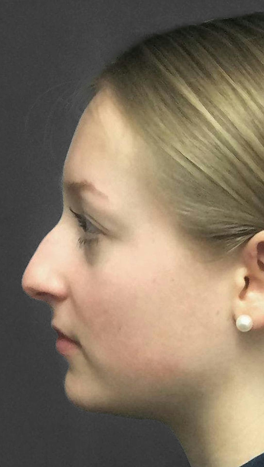 Non-Surgical Rhinoplasty Before & After Gallery - Patient 151452165 - Image 5