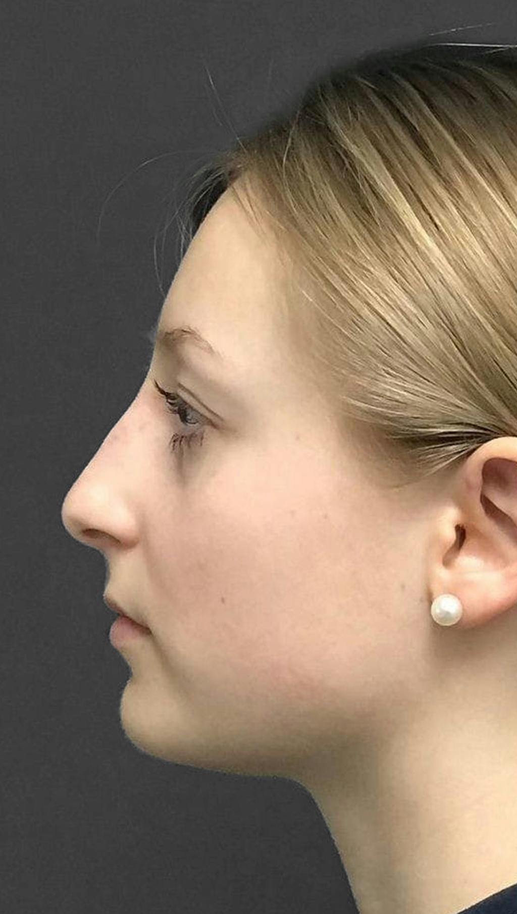 Non-Surgical Rhinoplasty Before & After Gallery - Patient 151452165 - Image 6