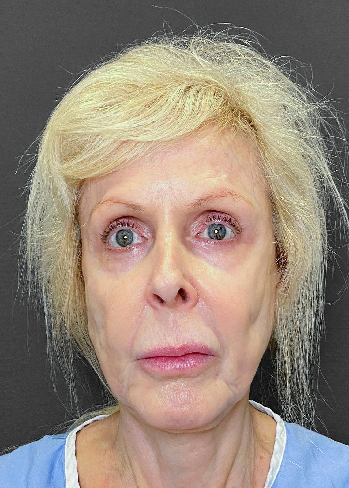 Facelifts / Necklift Before & After Gallery - Patient 151452107 - Image 5
