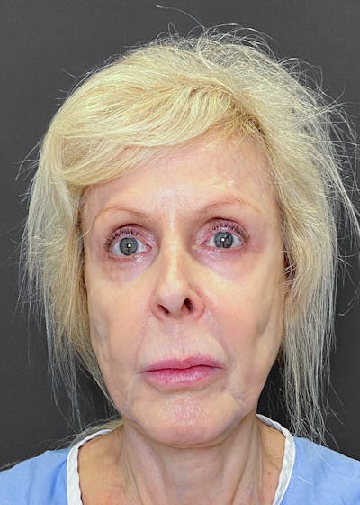 Facelift / Necklift Before & After Gallery - Patient 151452107 - Image 1