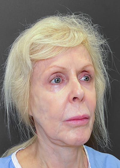 Facelifts / Necklift Before & After Gallery - Patient 151452107 - Image 2