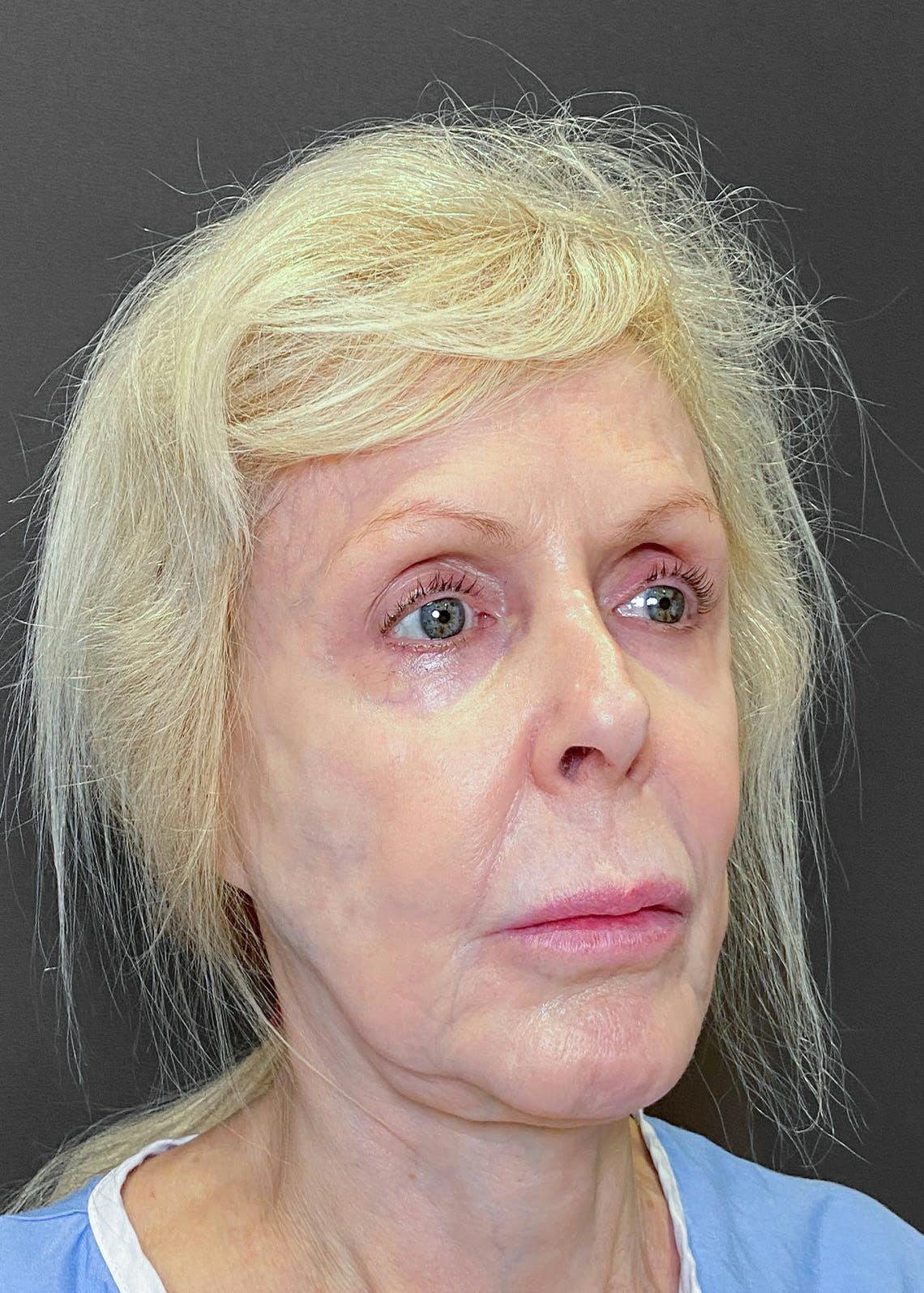 Facelift / Necklift Before & After Gallery - Patient 151452107 - Image 3