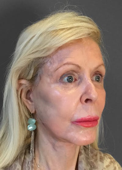 Facelifts / Necklift Before & After Gallery - Patient 151452107 - Image 1