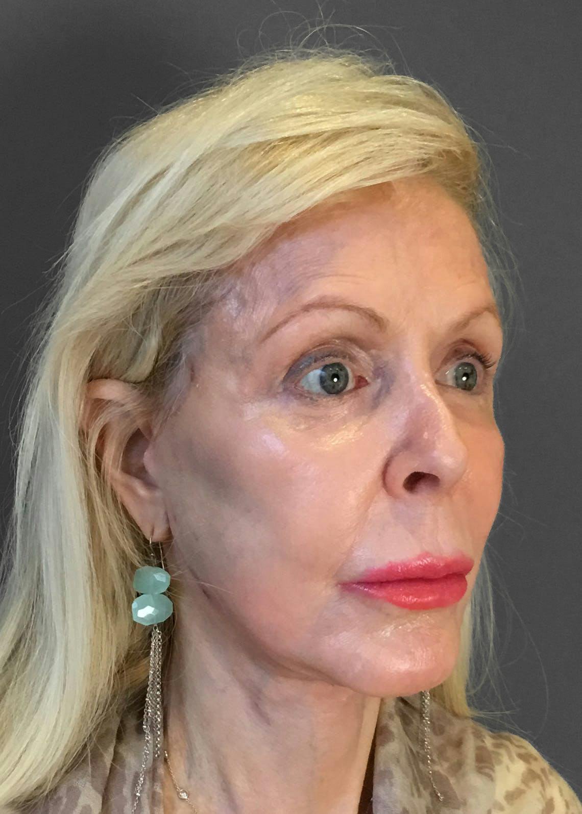 Facelifts / Necklift Before & After Gallery - Patient 151452107 - Image 4