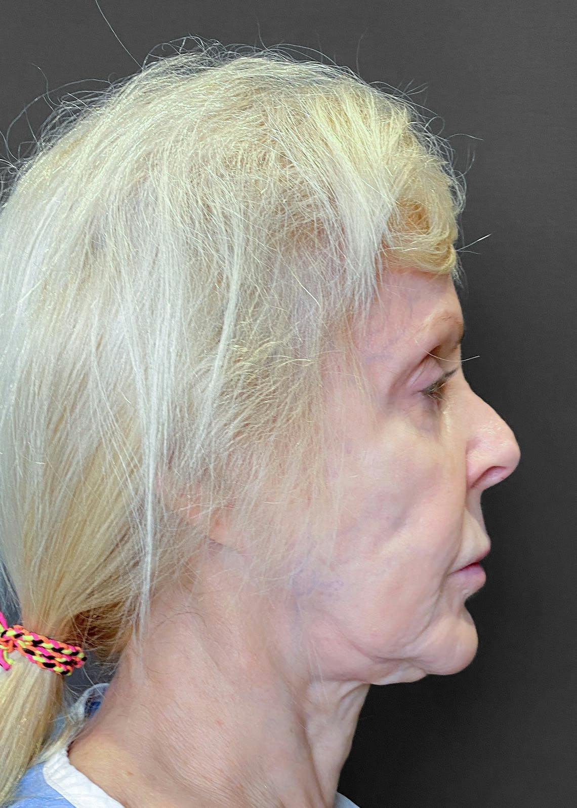 Facelift / Necklift Before & After Gallery - Patient 151452107 - Image 5
