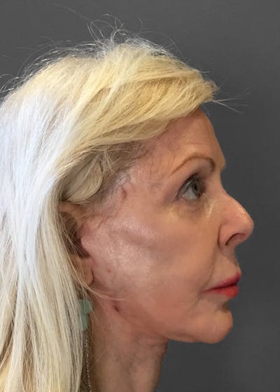 Facelifts / Necklift Before & After Gallery - Patient 151452107 - Image 2