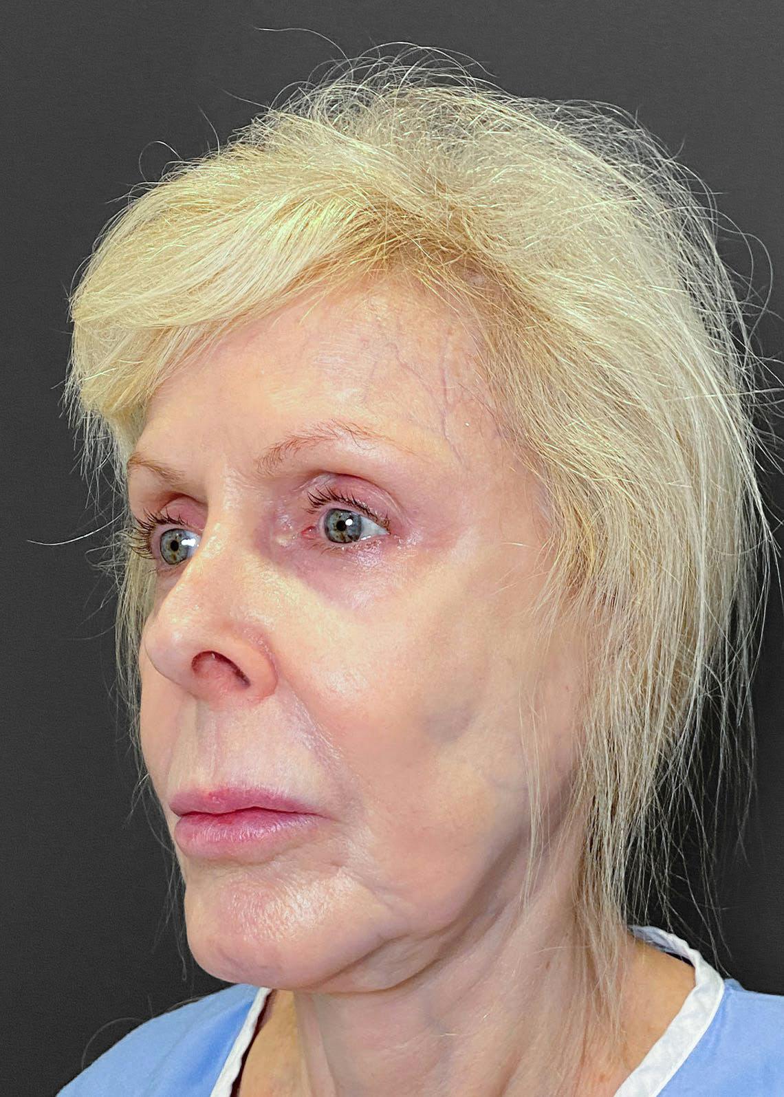 Facelift / Necklift Before & After Gallery - Patient 151452107 - Image 7