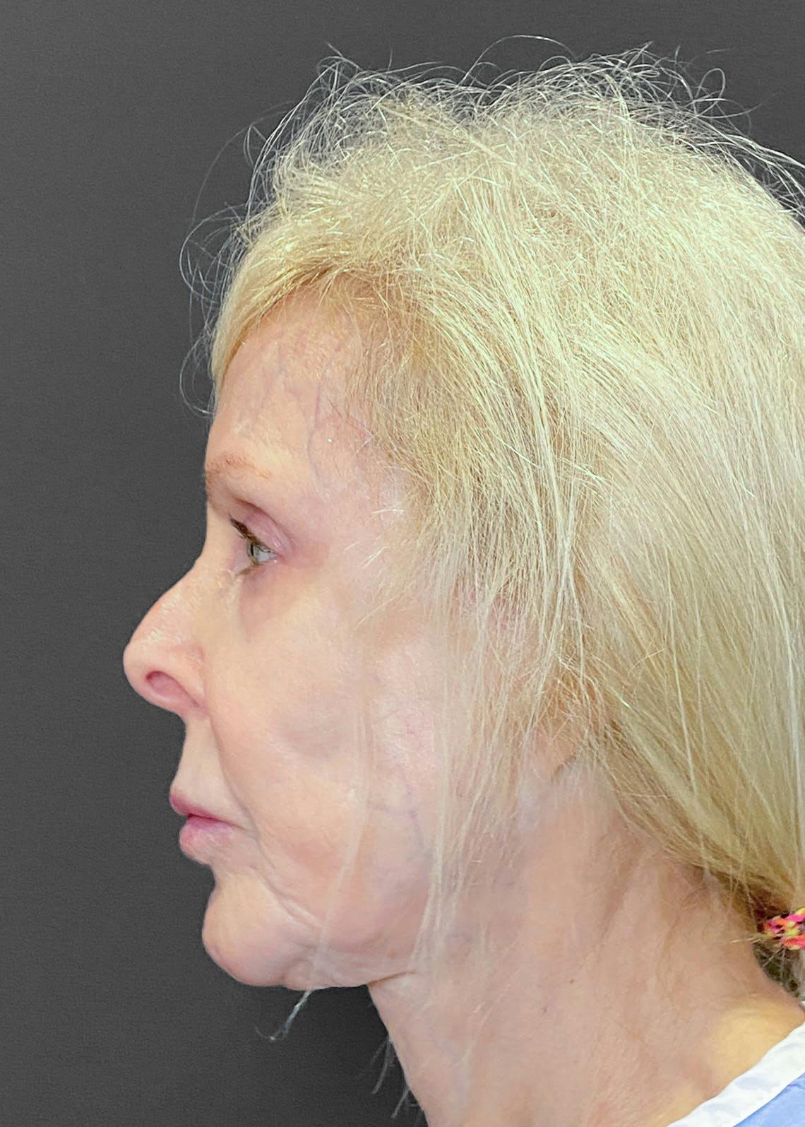 Facelifts / Necklift Before & After Gallery - Patient 151452107 - Image 9