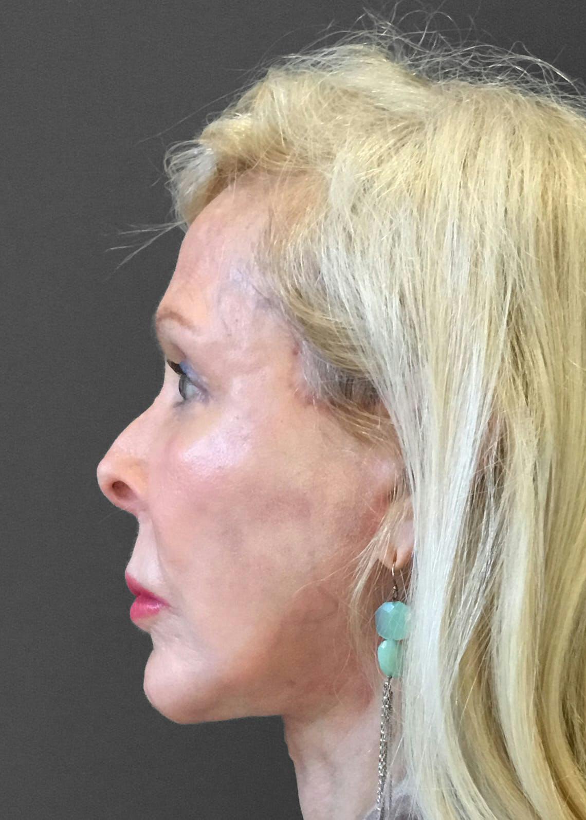 Facelift / Necklift Before & After Gallery - Patient 151452107 - Image 10
