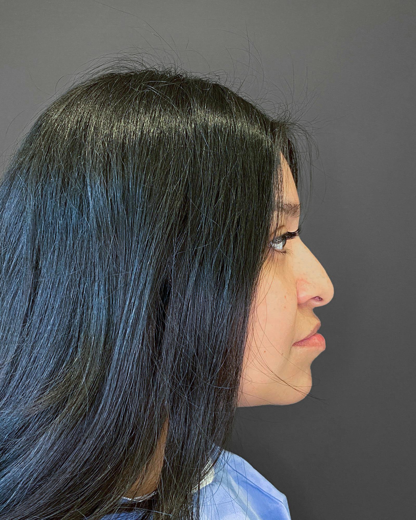 Rhinoplasty Before & After Gallery - Patient 151510793 - Image 1
