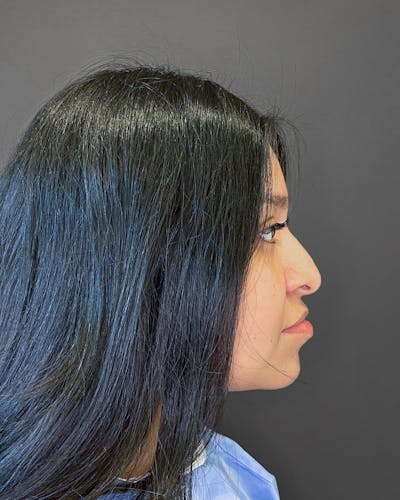 Rhinoplasty Before & After Gallery - Patient 151510793 - Image 1