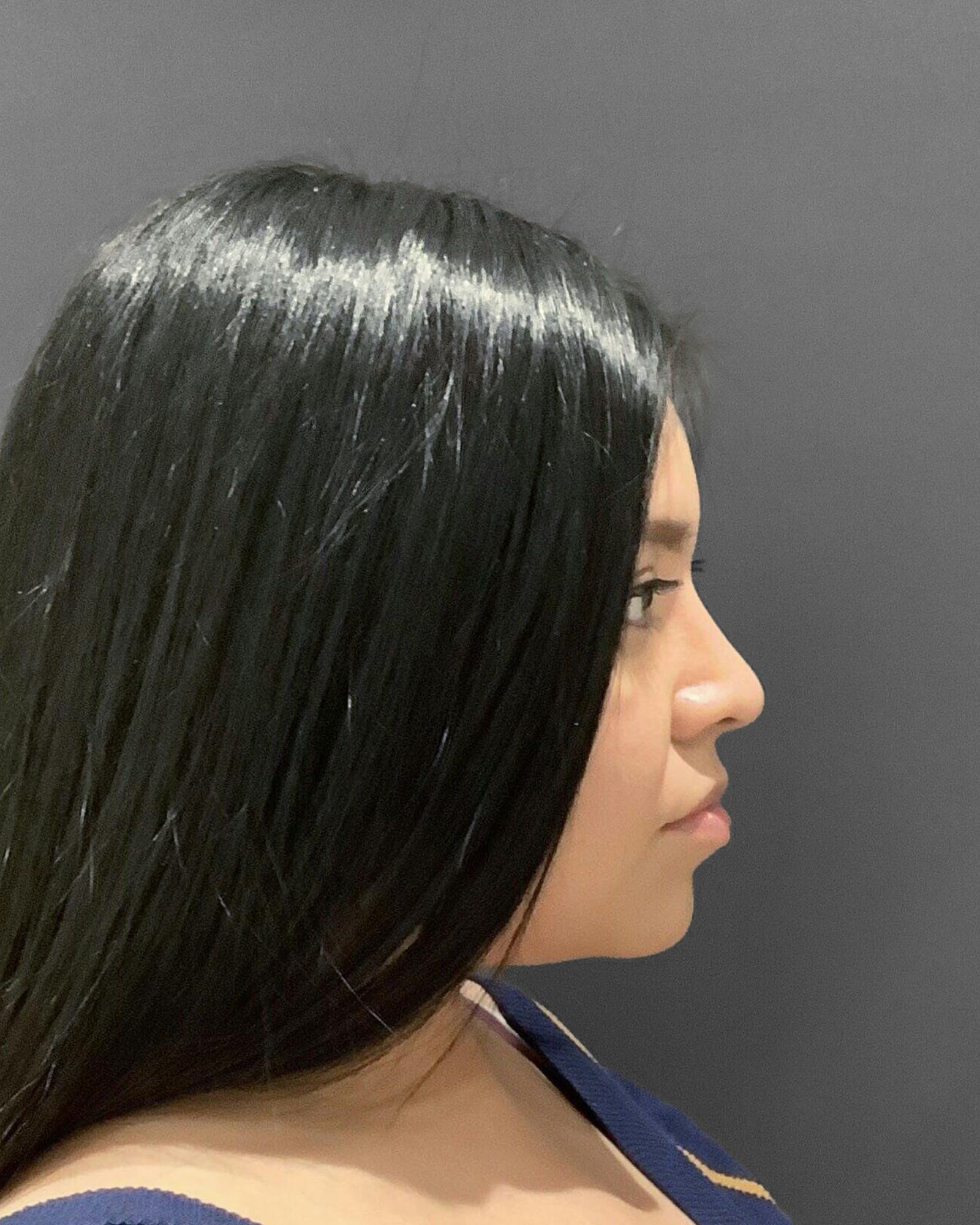 Rhinoplasty Before & After Gallery - Patient 151510793 - Image 2