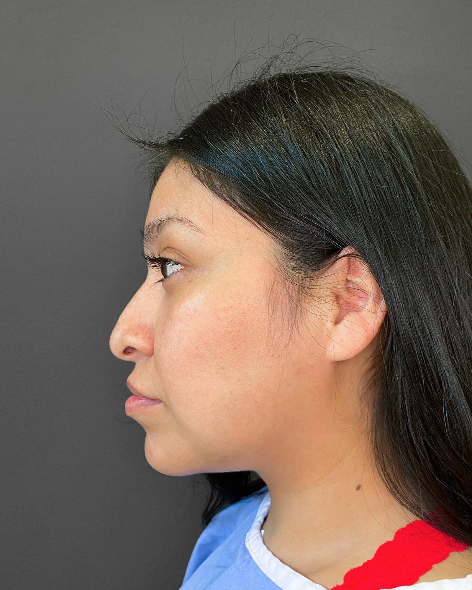 Rhinoplasty Before & After Gallery - Patient 151510793 - Image 7