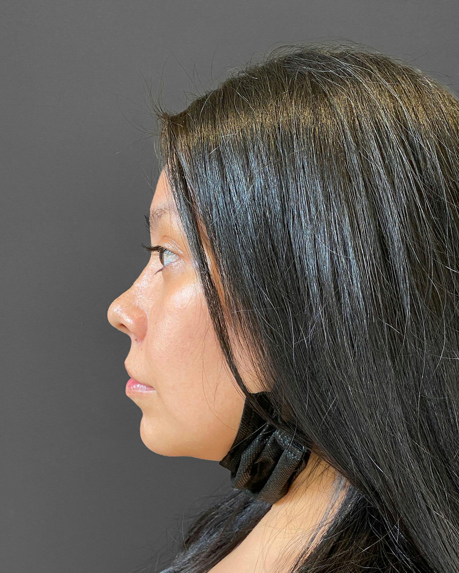 Rhinoplasty Before & After Gallery - Patient 151510793 - Image 8