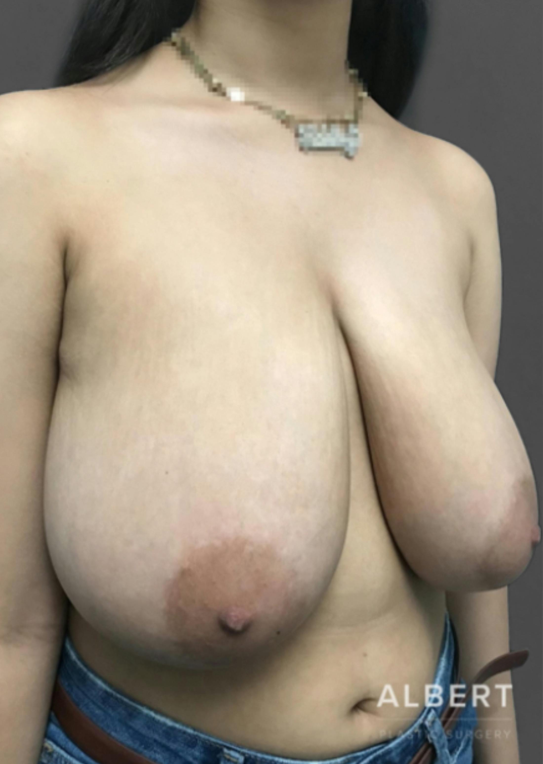 Breast Reduction Before & After Gallery - Patient 174193960 - Image 3