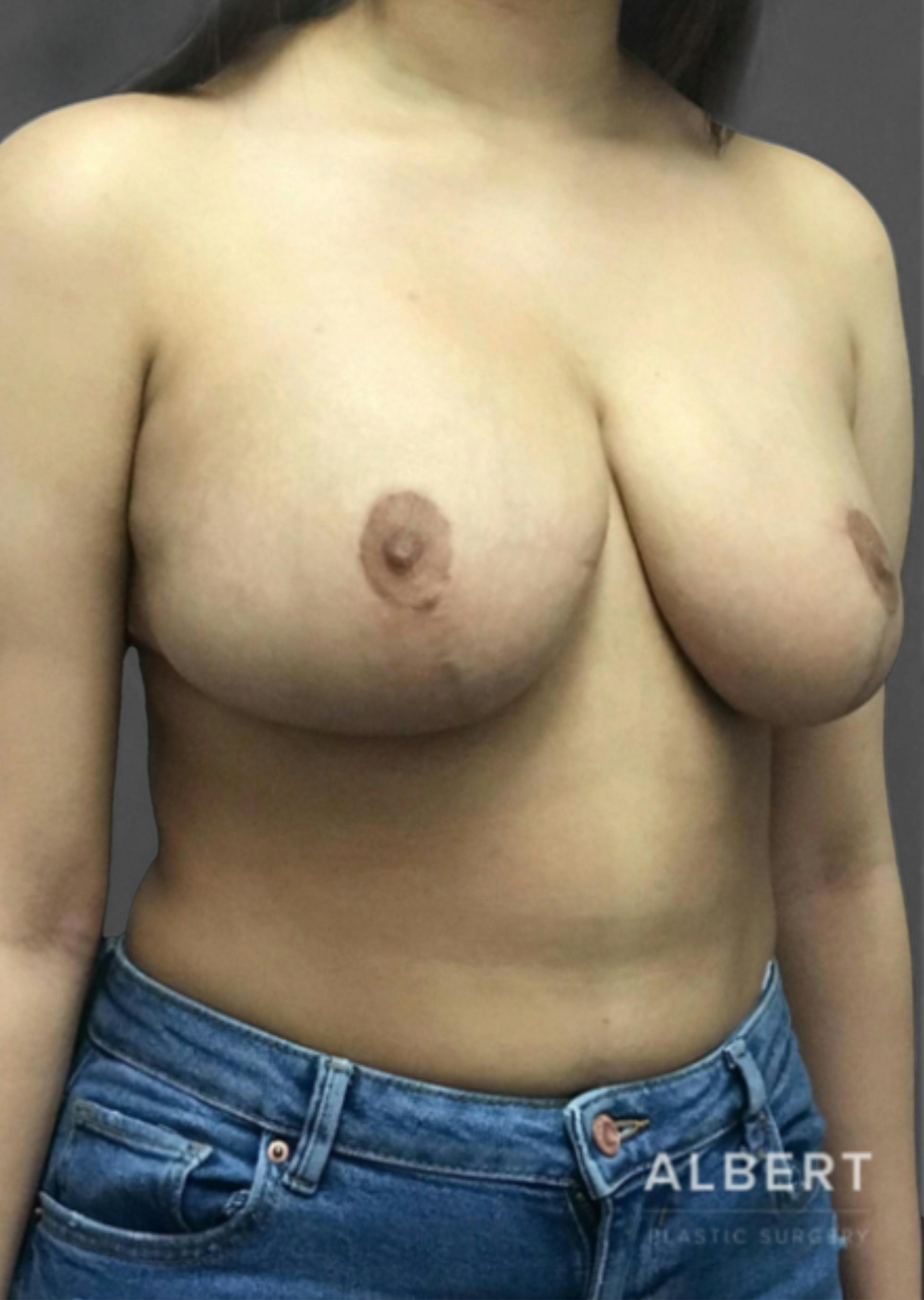 Breast Reduction Before & After Gallery - Patient 174193960 - Image 4
