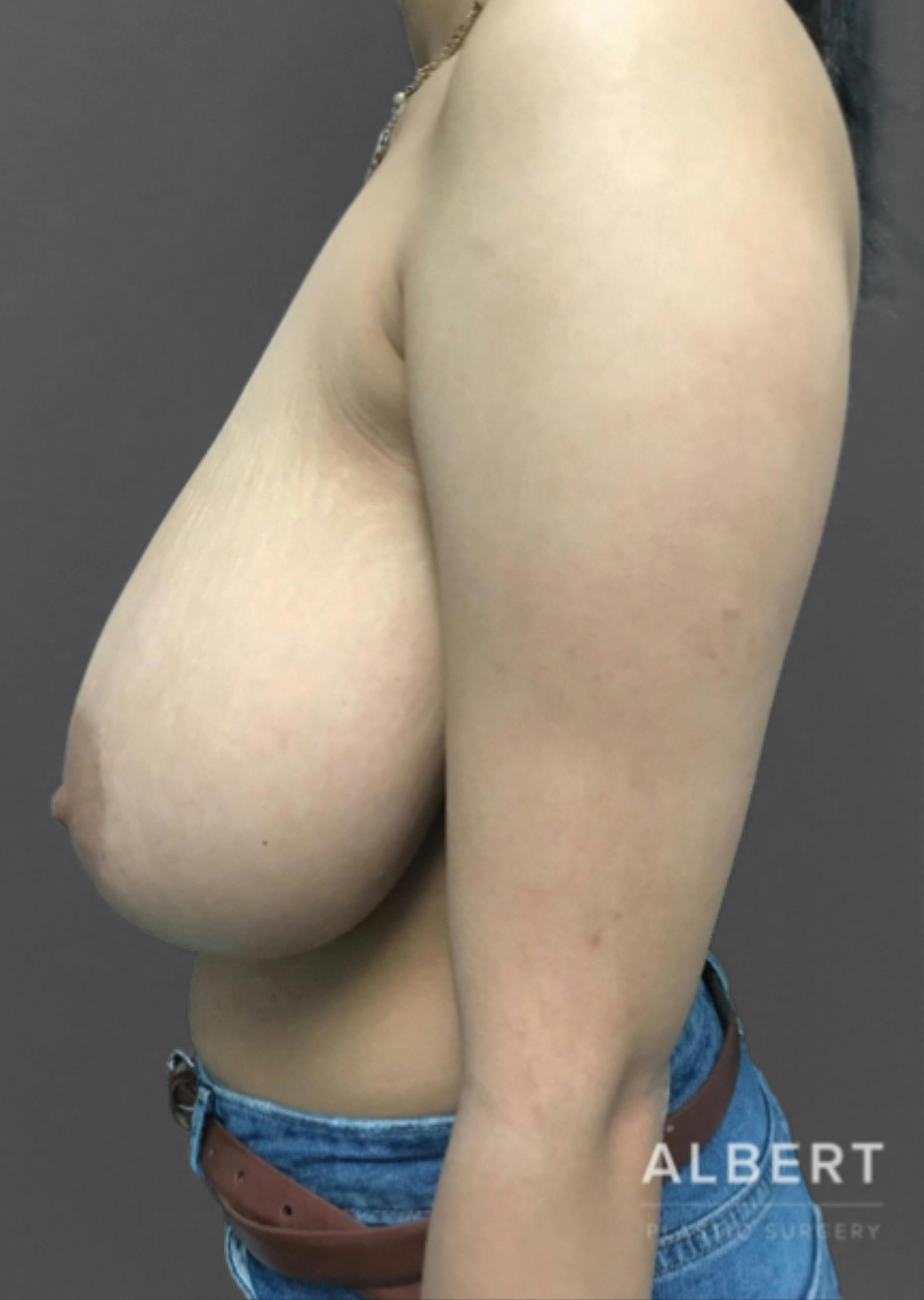 Breast Reduction Before & After Gallery - Patient 174193960 - Image 5