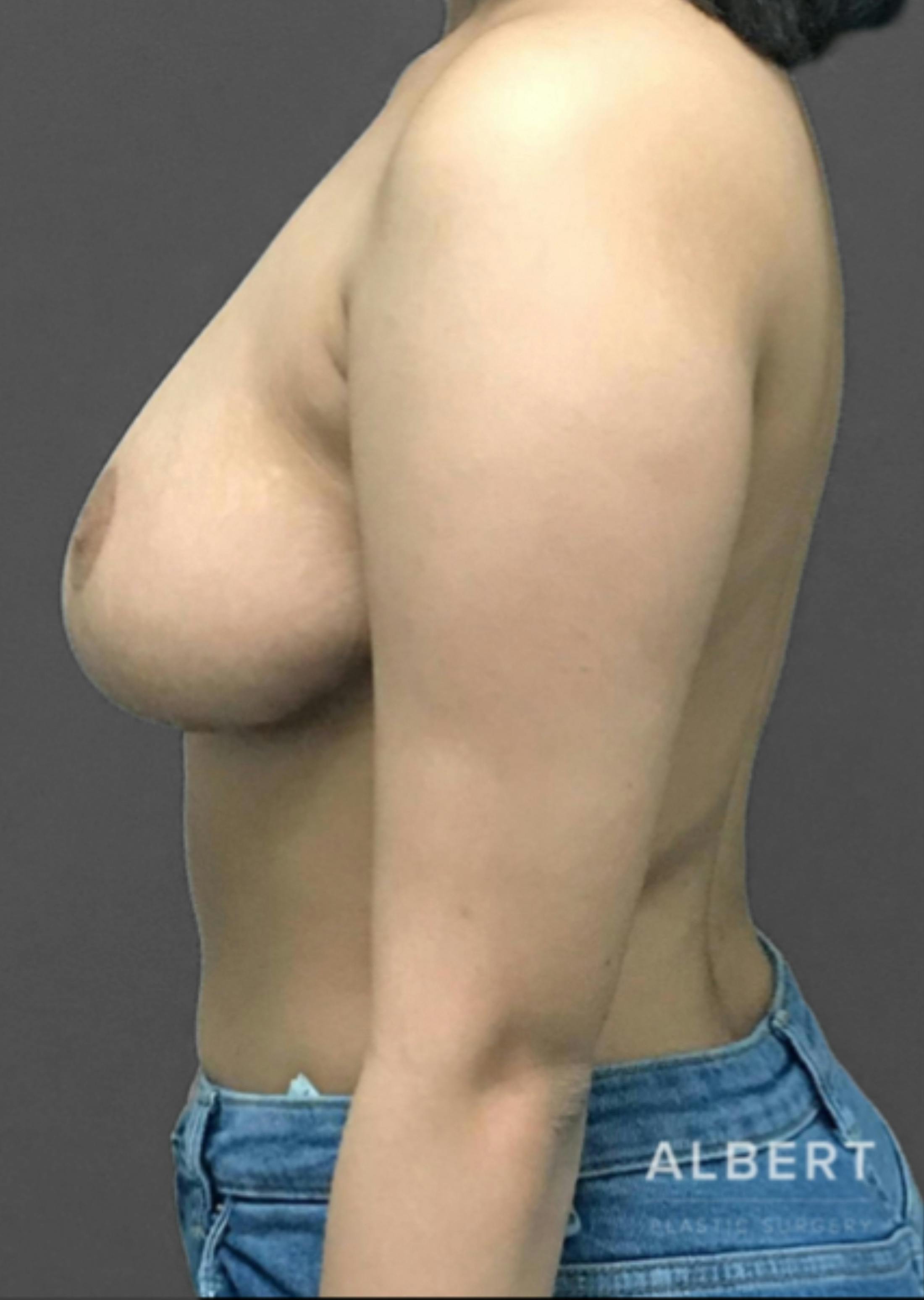 Breast Reduction Before & After Gallery - Patient 174193960 - Image 6