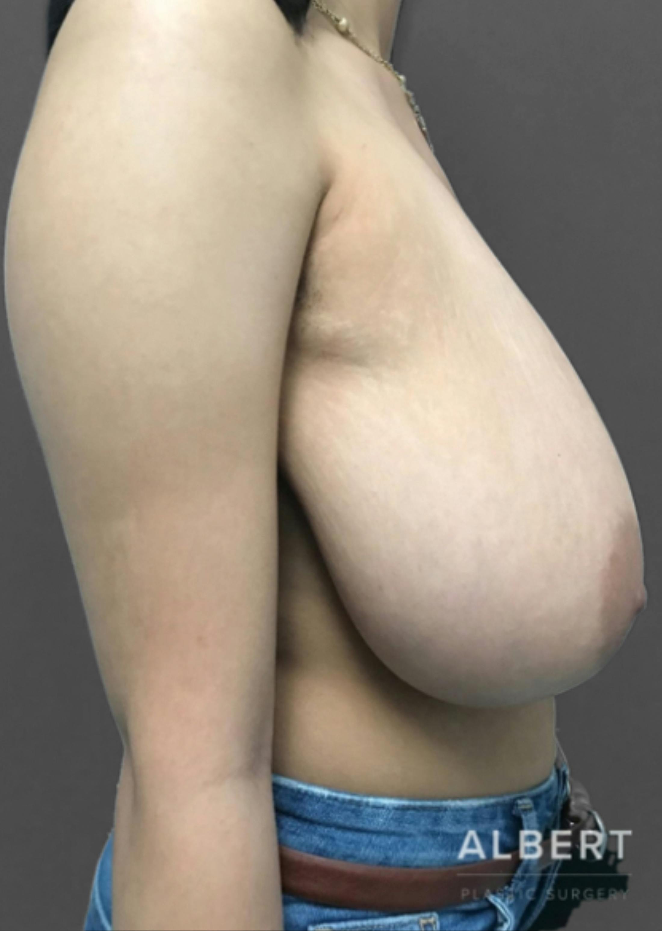 Breast Reduction Before & After Gallery - Patient 174193960 - Image 9