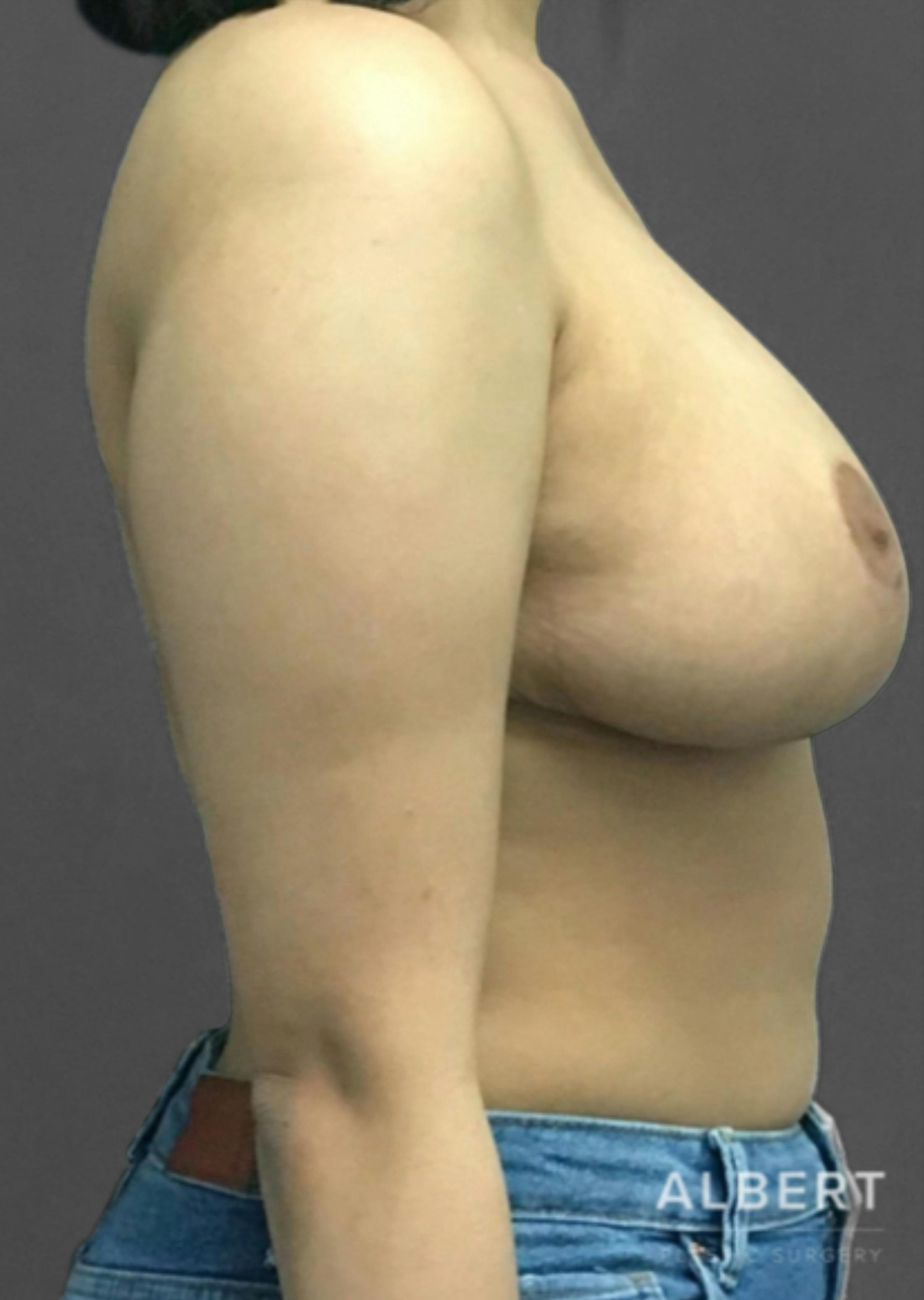 Breast Reduction Before & After Gallery - Patient 174193960 - Image 10