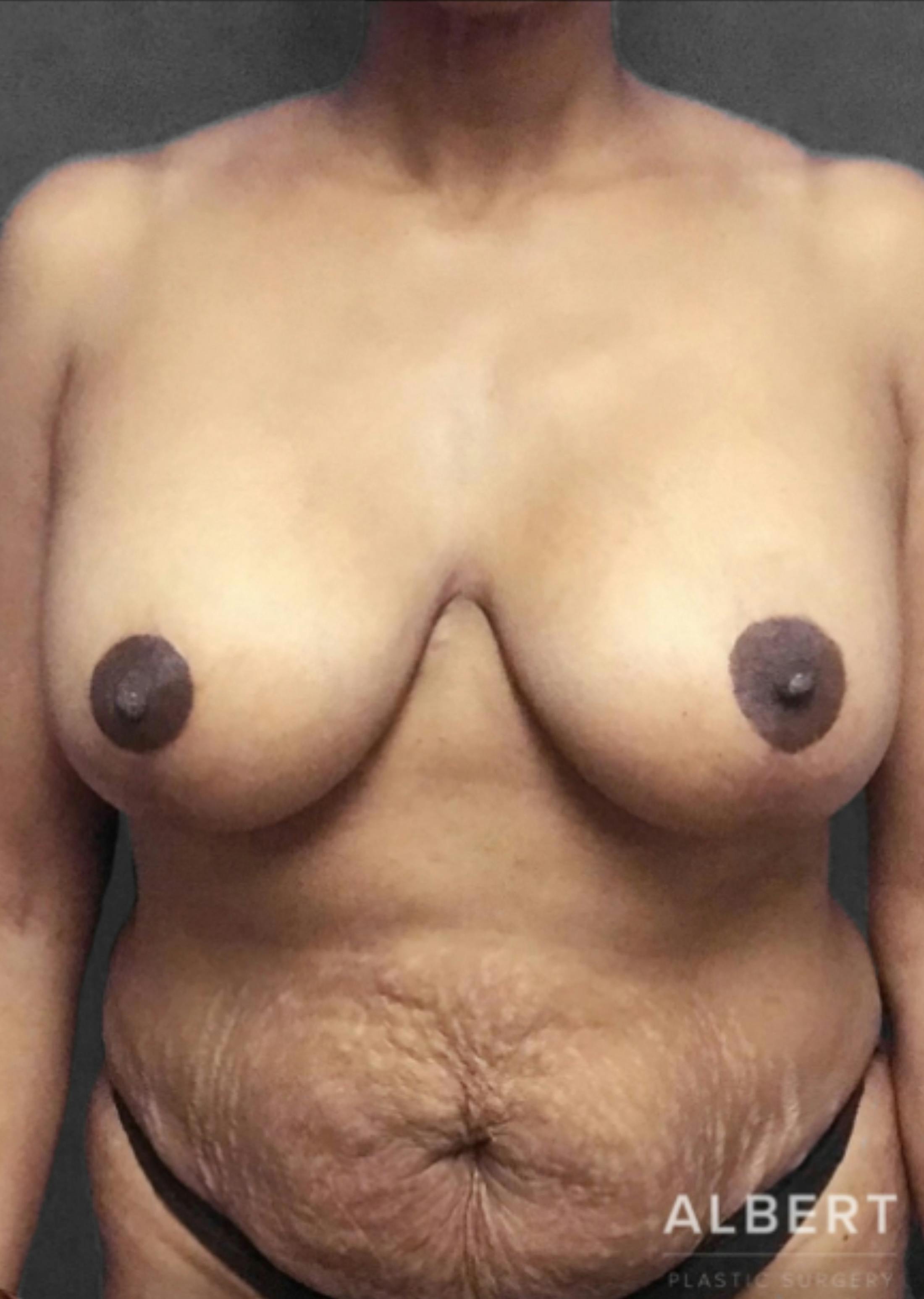 Breast Reduction Before & After Gallery - Patient 174250763 - Image 2