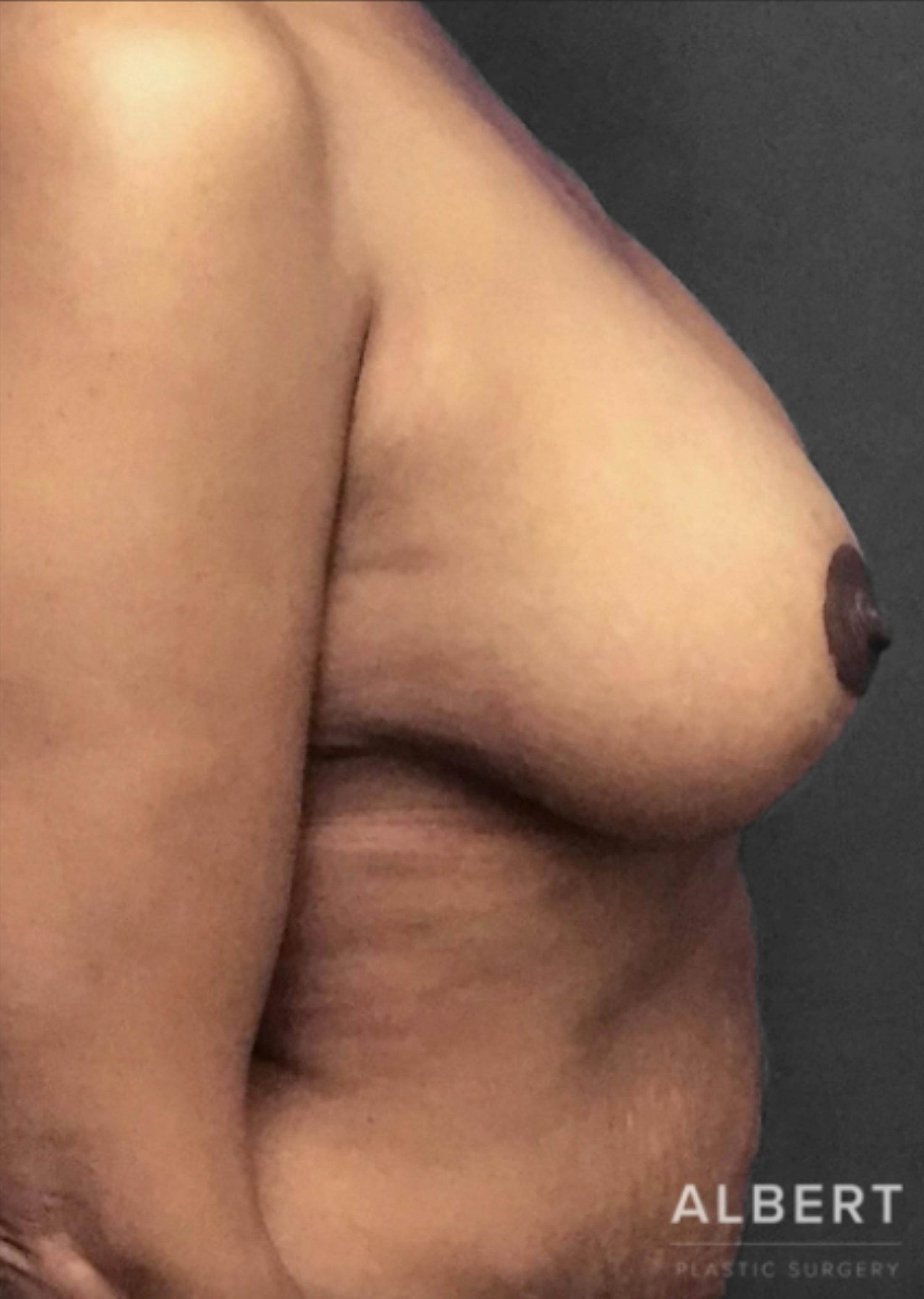 Breast Reduction Before & After Gallery - Patient 174250763 - Image 6