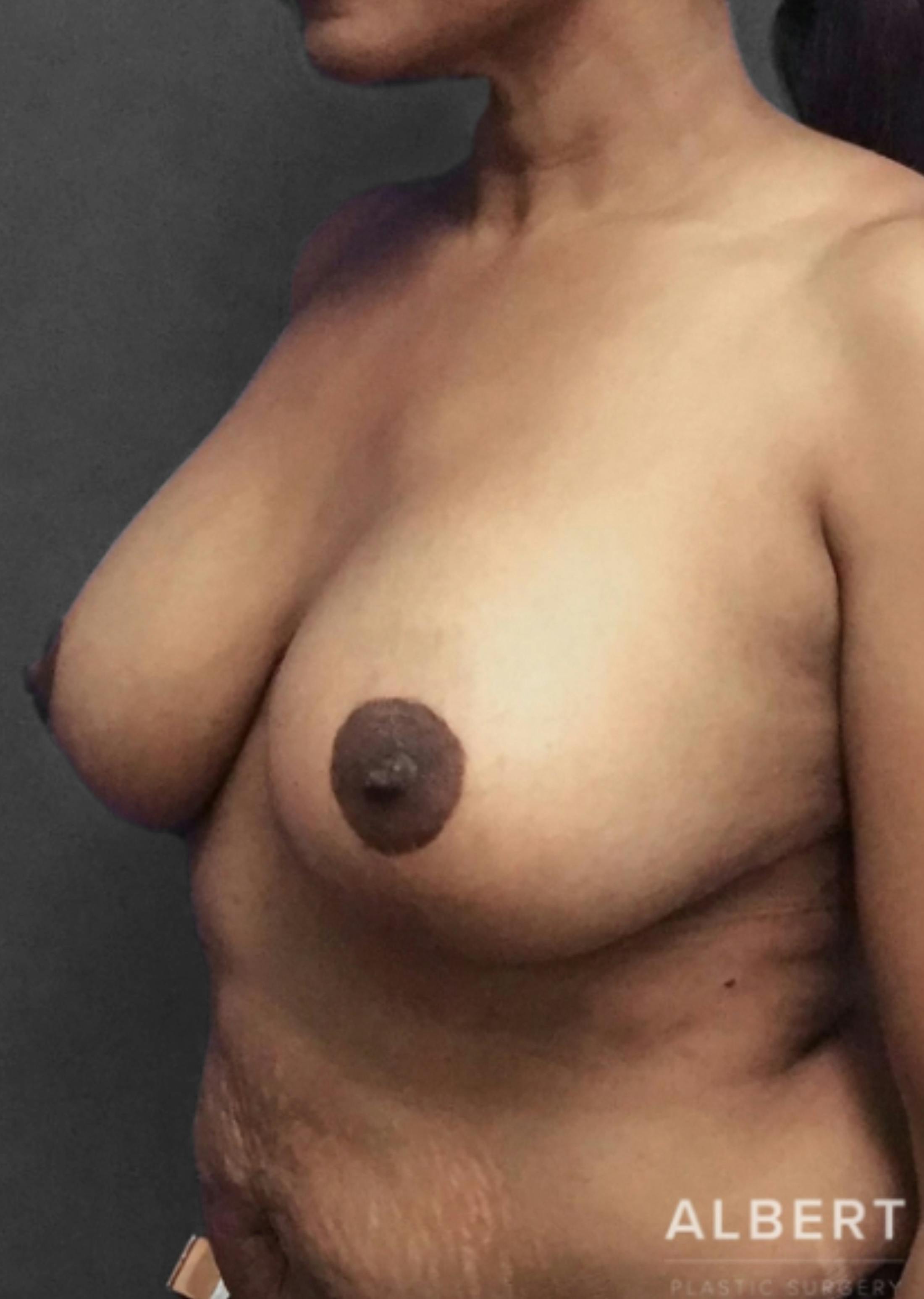 Breast Reduction Before & After Gallery - Patient 174250763 - Image 10