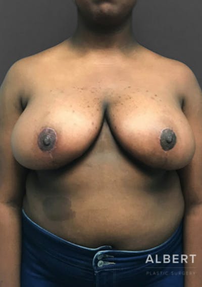 Breast Reduction Before & After Gallery - Patient 174250764 - Image 2