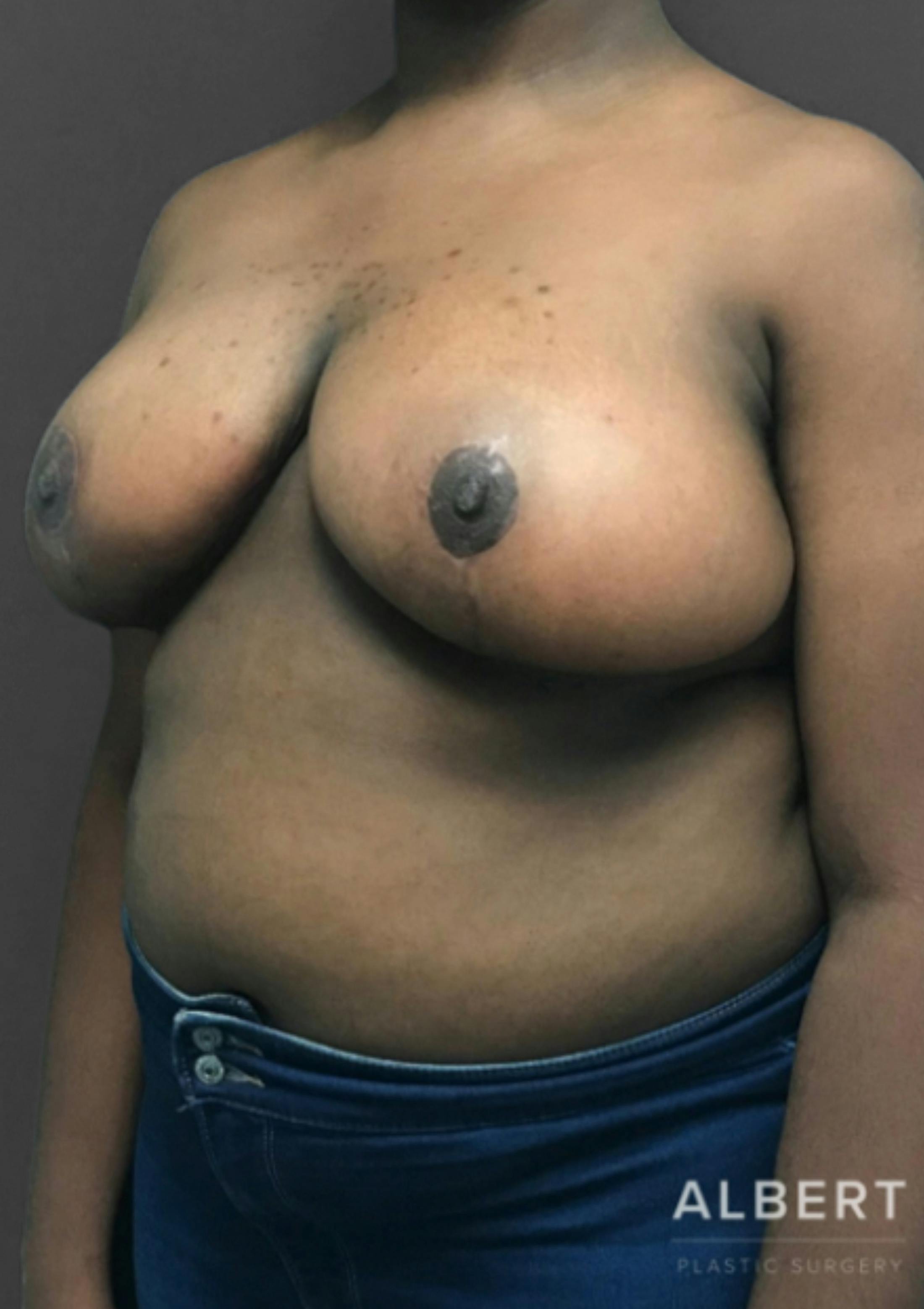 Breast Reduction Before & After Gallery - Patient 174250764 - Image 4