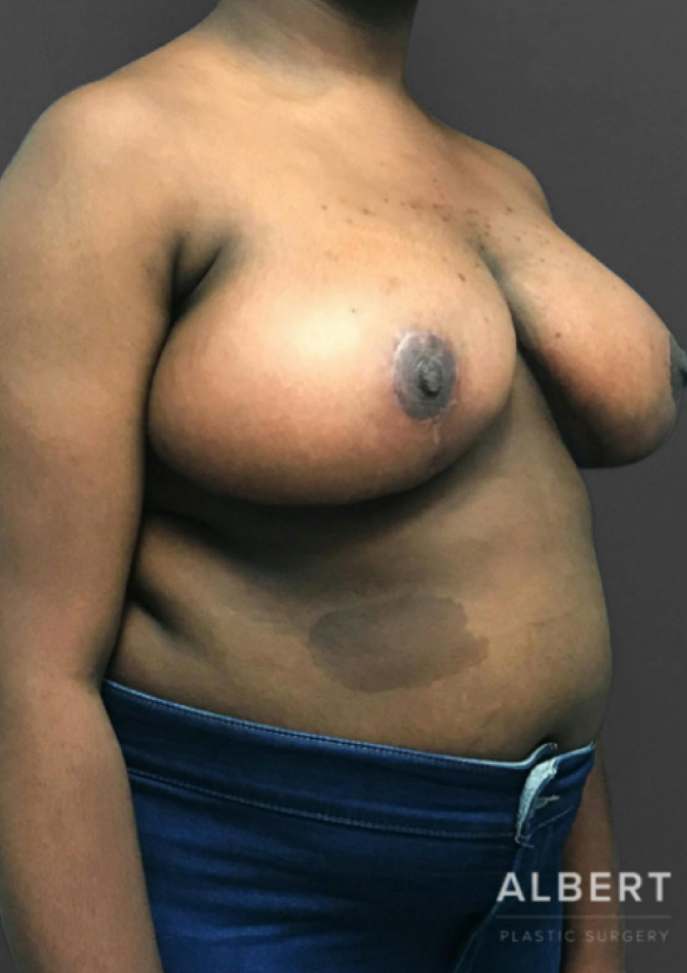 Breast Reduction Before & After Gallery - Patient 174250764 - Image 6