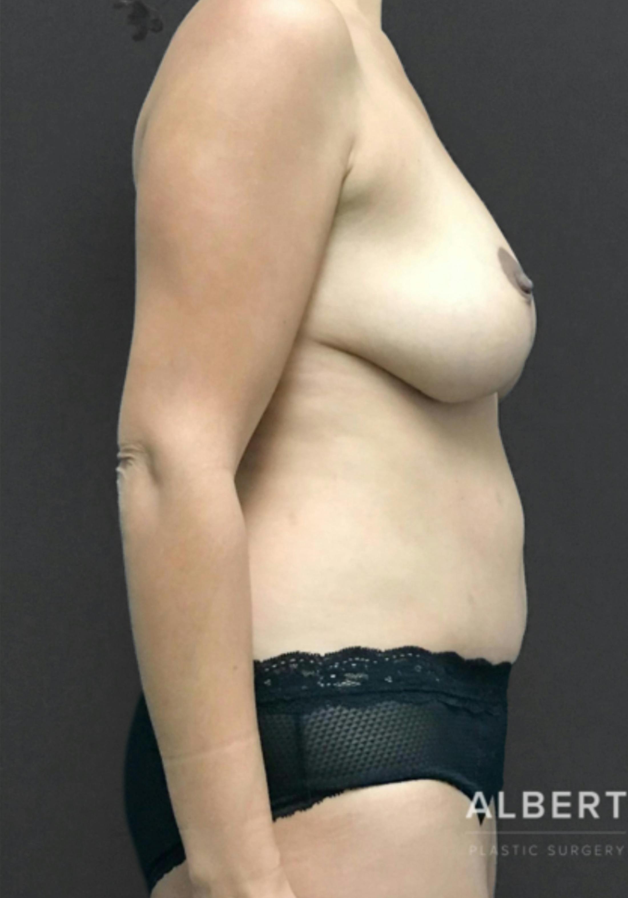 Breast Reduction Before & After Gallery - Patient 174274249 - Image 8