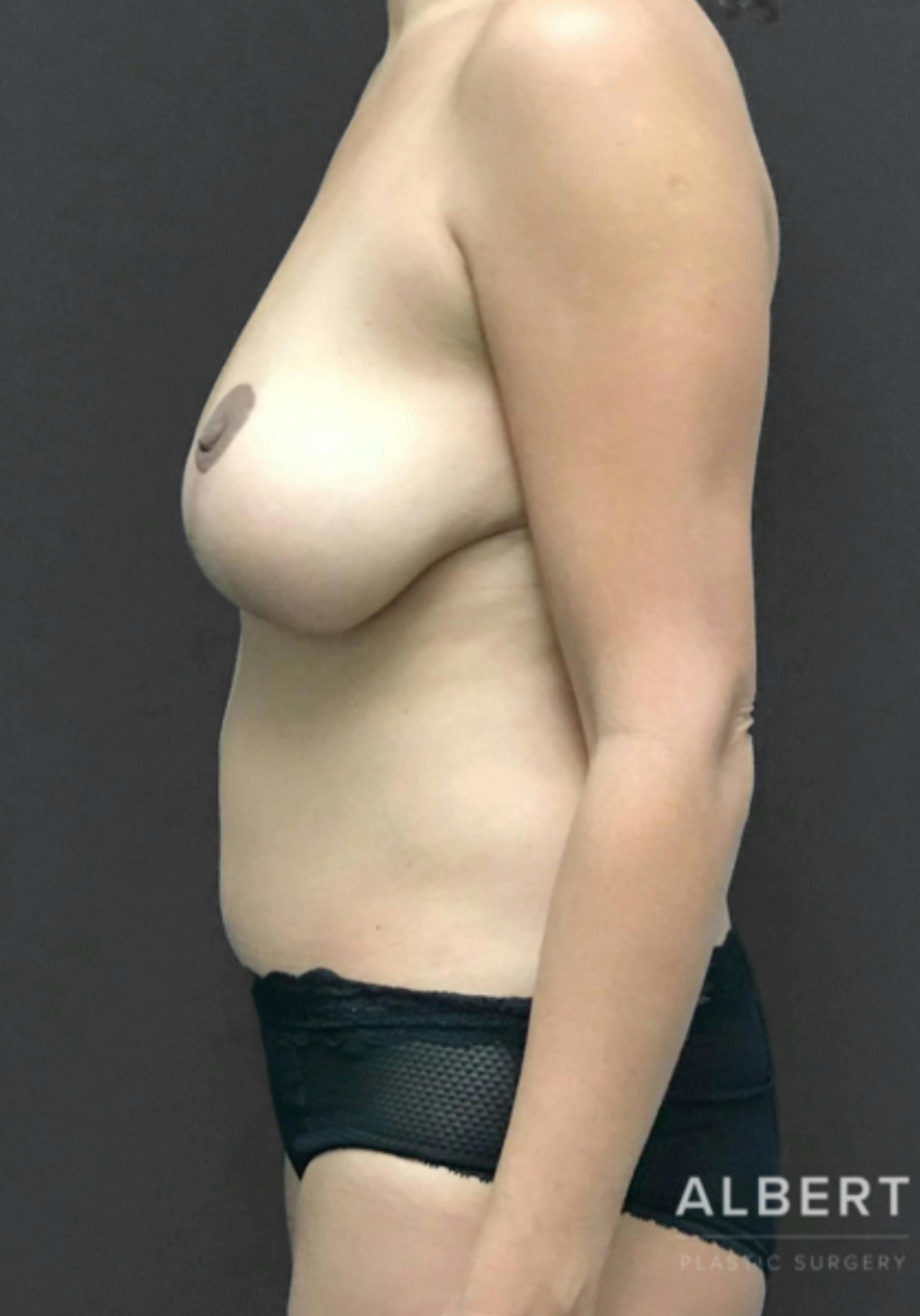 Breast Reduction Before & After Gallery - Patient 174274249 - Image 10