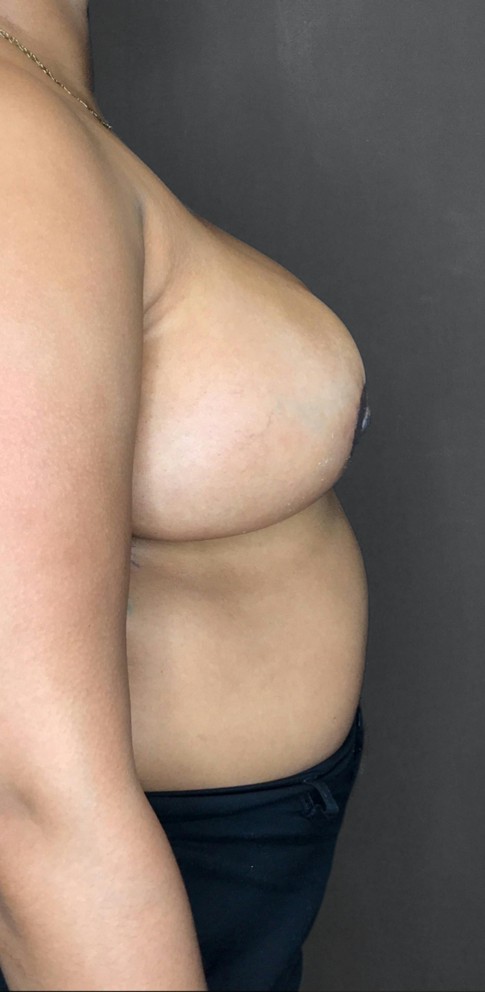 Breast Reduction Before & After Gallery - Patient 174274250 - Image 2