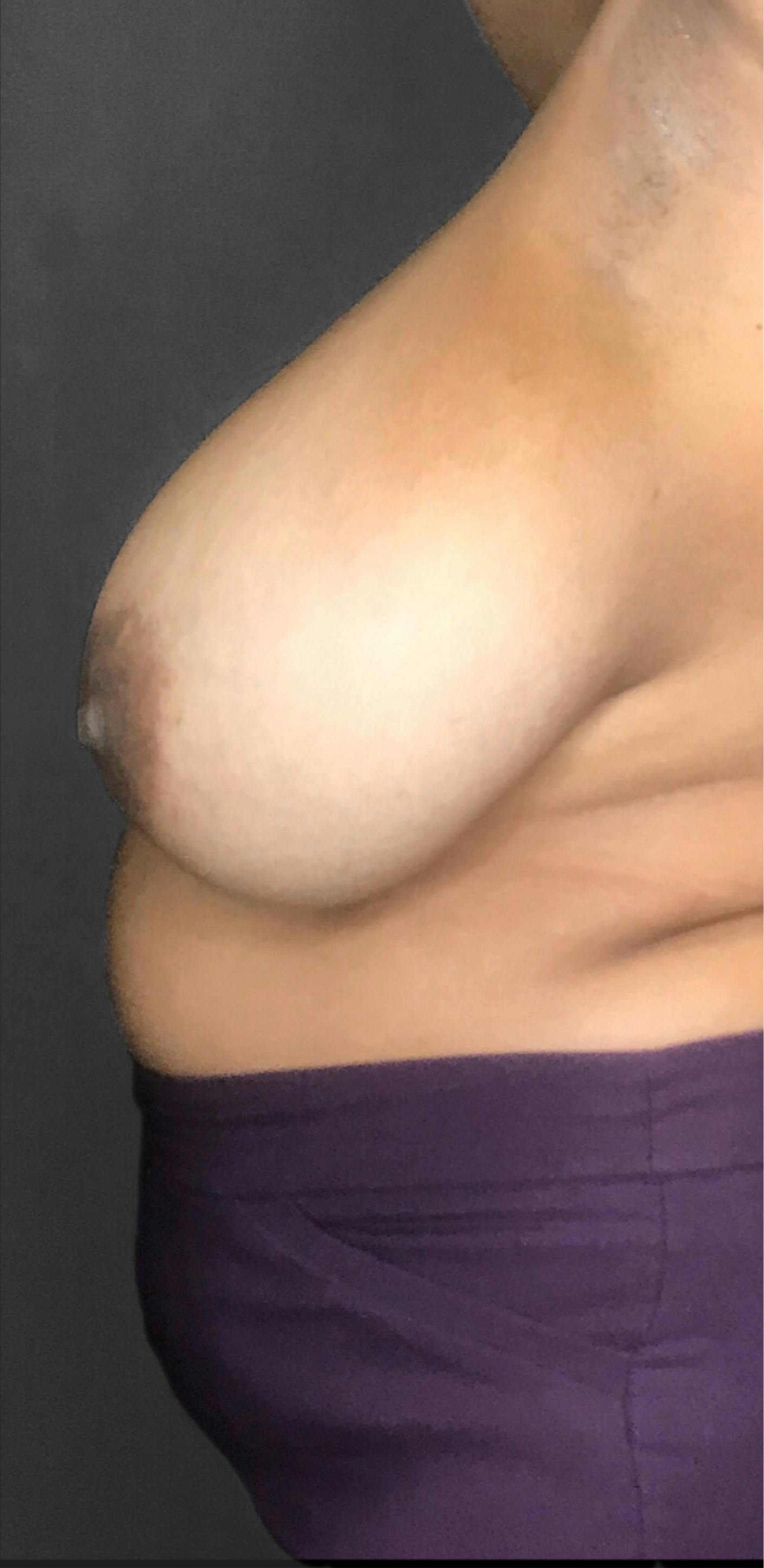 Breast Reduction Before & After Gallery - Patient 174274250 - Image 3