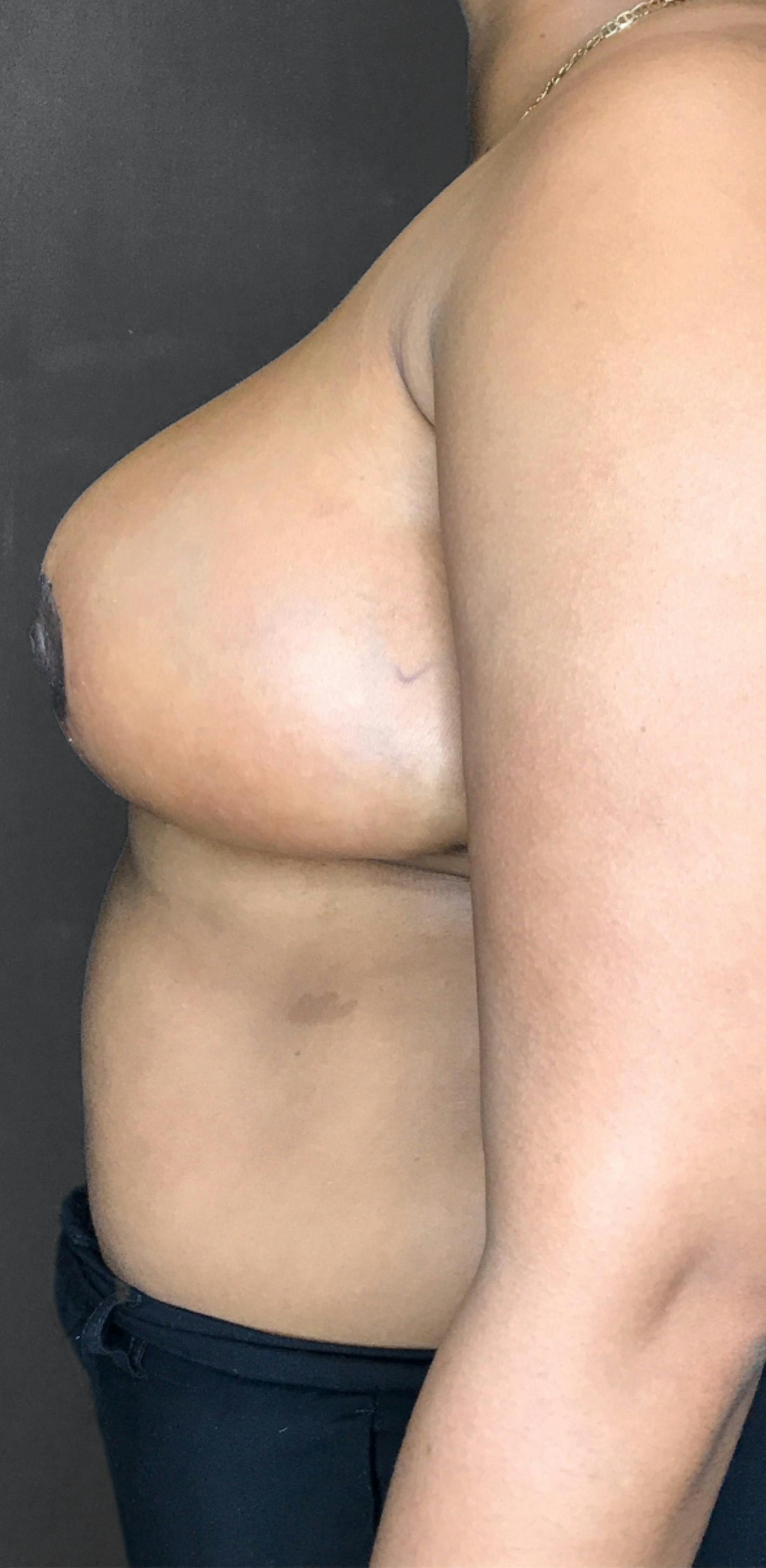 Breast Reduction Before & After Gallery - Patient 174274250 - Image 4