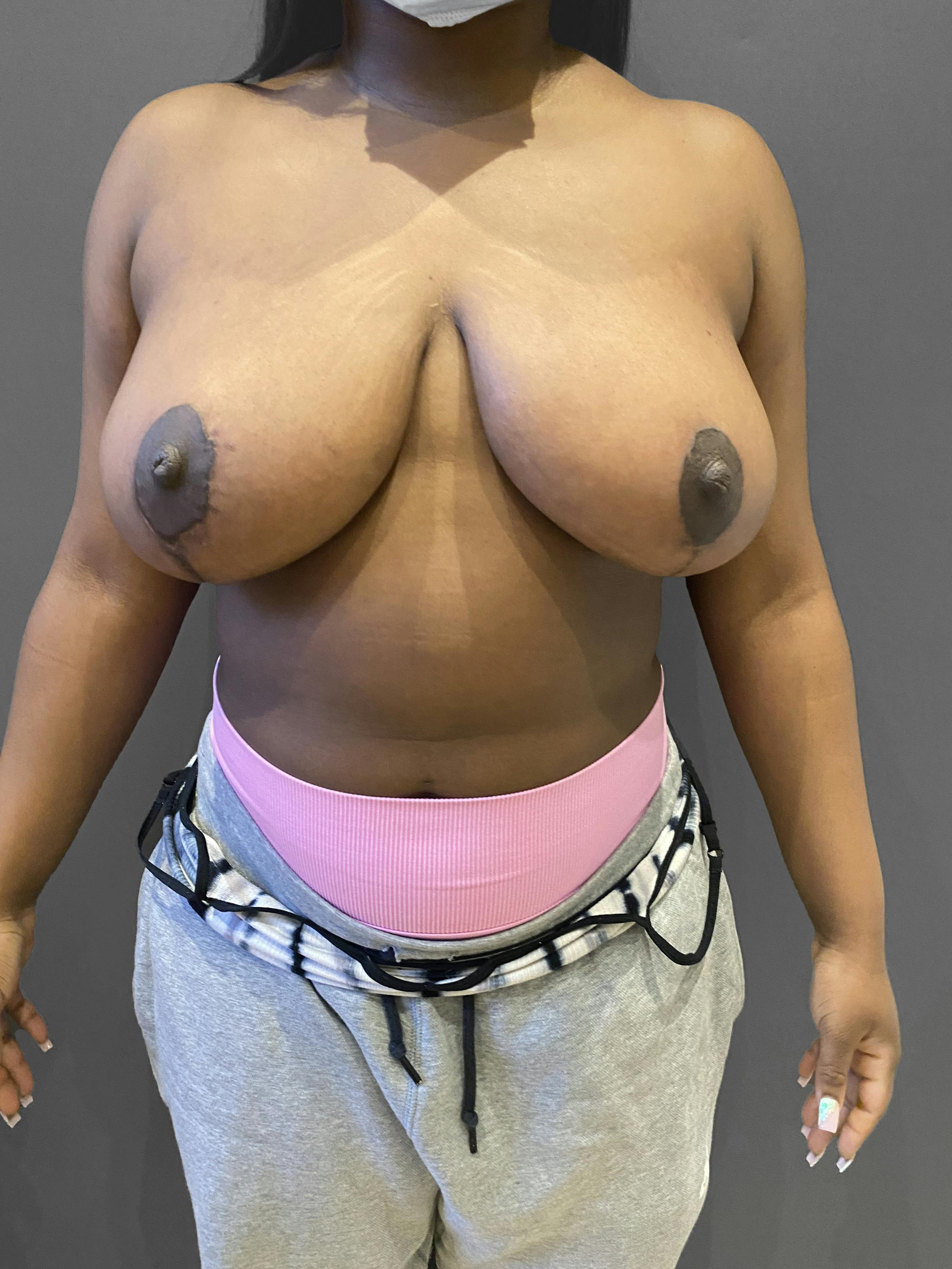 Breast Reduction Before & After Gallery - Patient 174274251 - Image 2