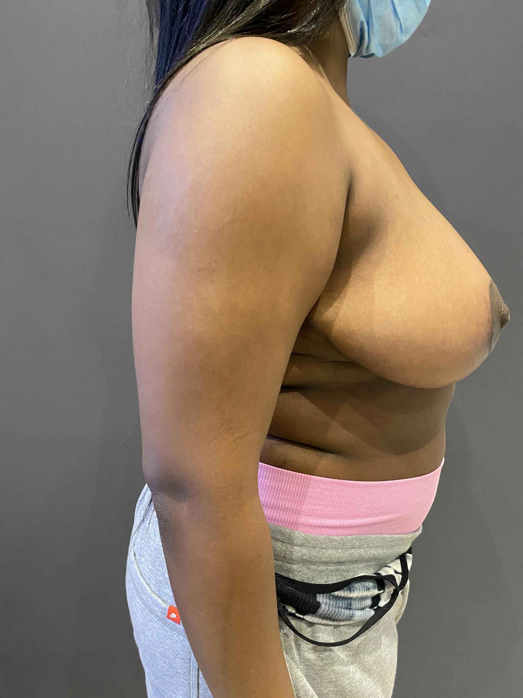 Breast Reduction Before & After Gallery - Patient 174274251 - Image 4
