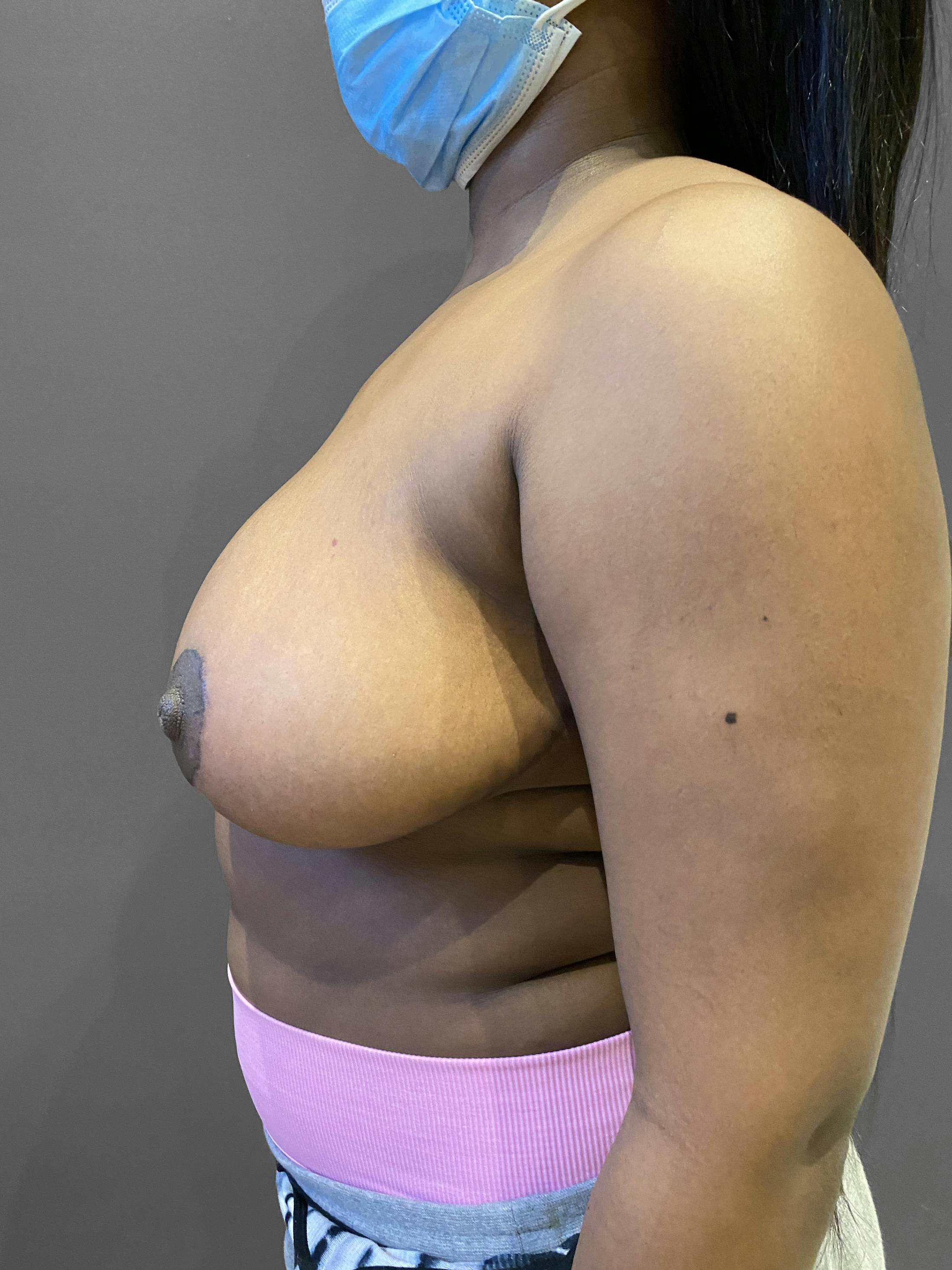 Breast Reduction Before & After Gallery - Patient 174274251 - Image 6