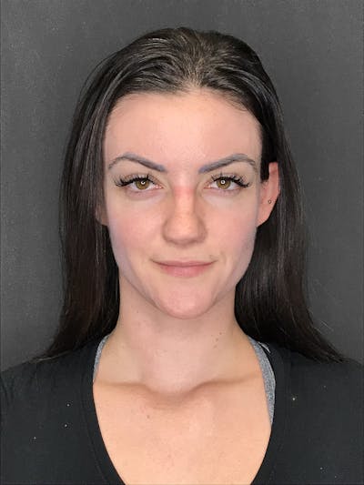 Facial Fat Transfer Before & After Gallery - Patient 151452115 - Image 1