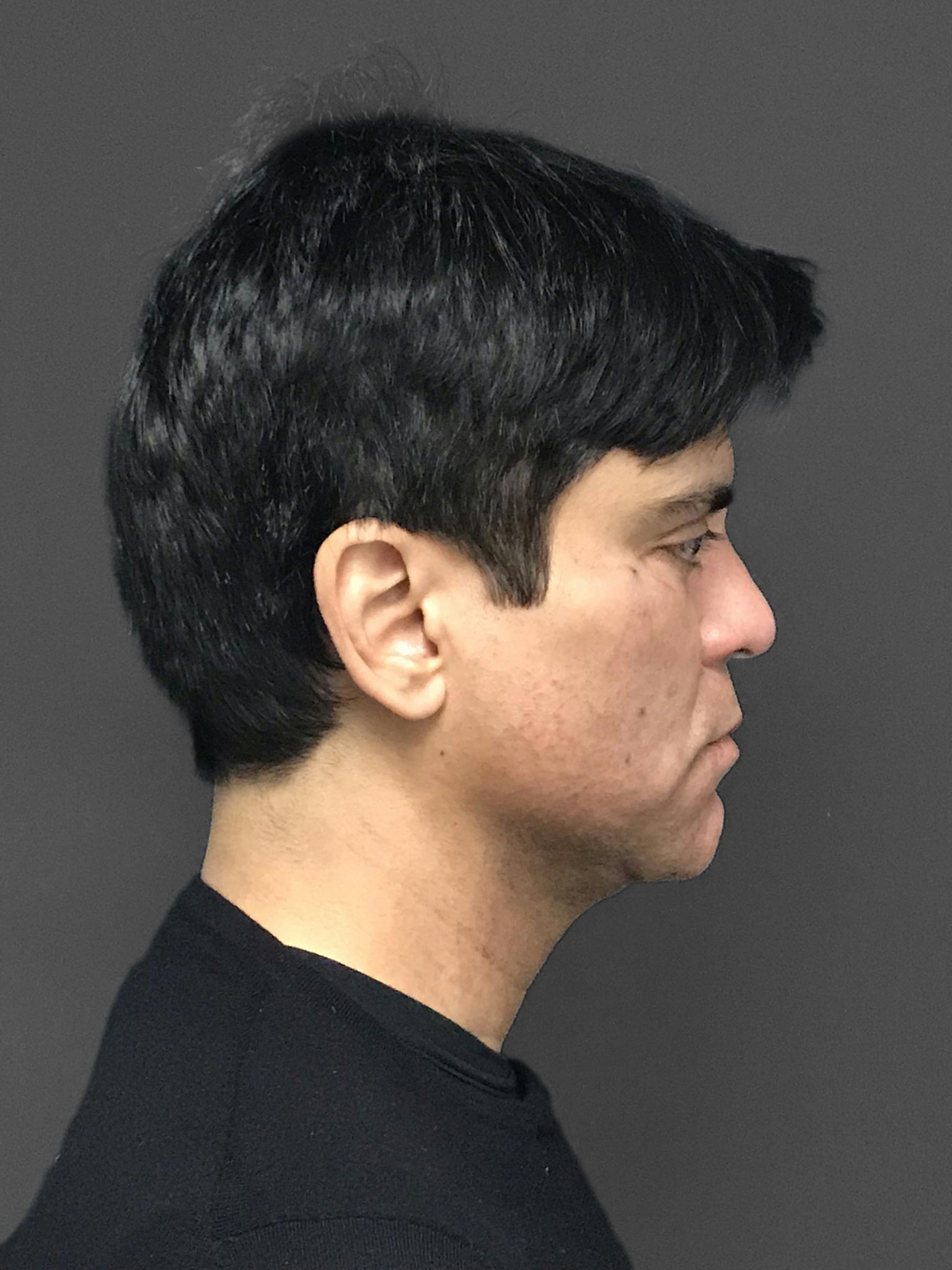 Facial Fat Transfer Before & After Gallery - Patient 151452117 - Image 9