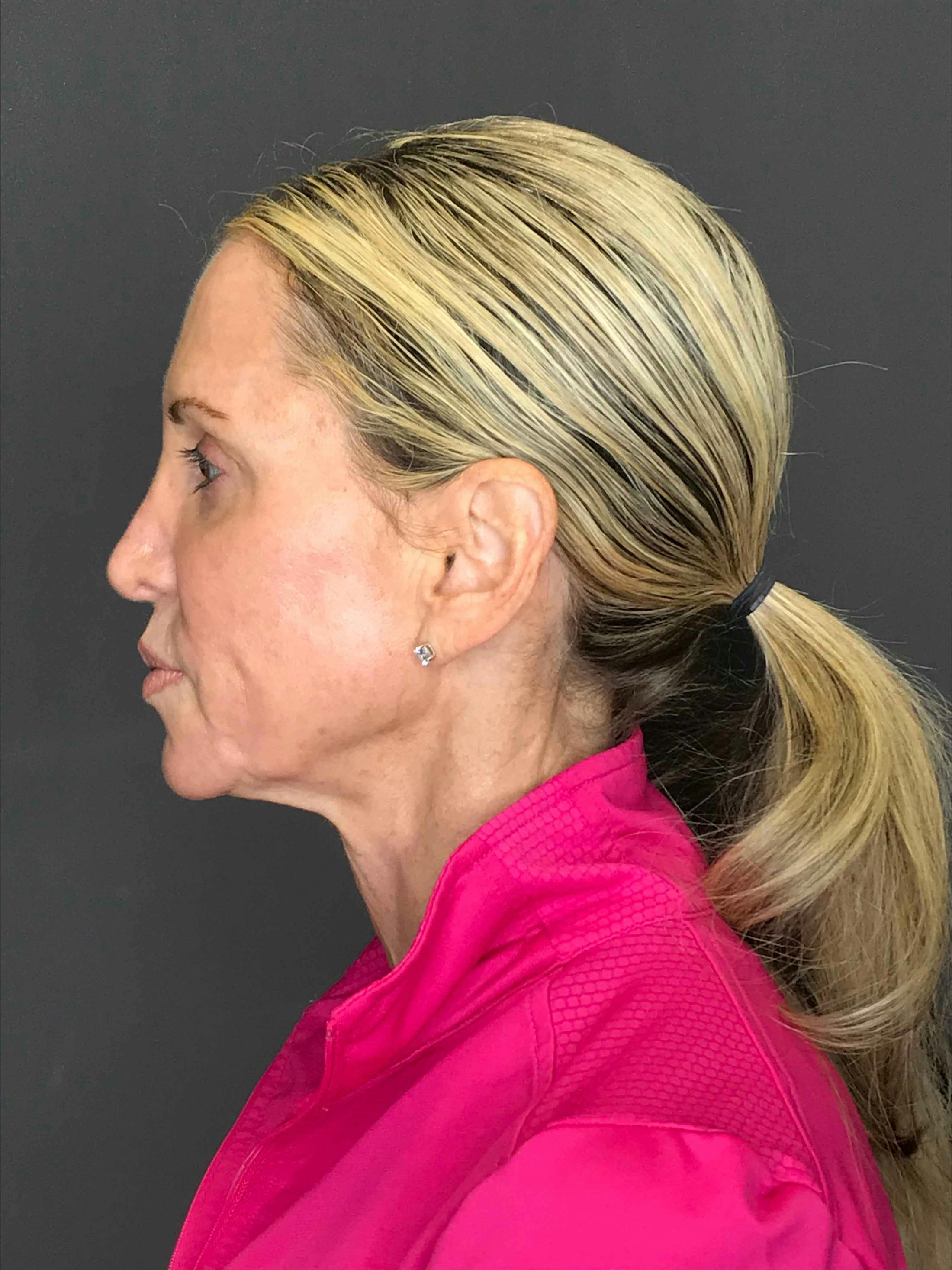 Facelift & Necklift before in NYC left side view p#1