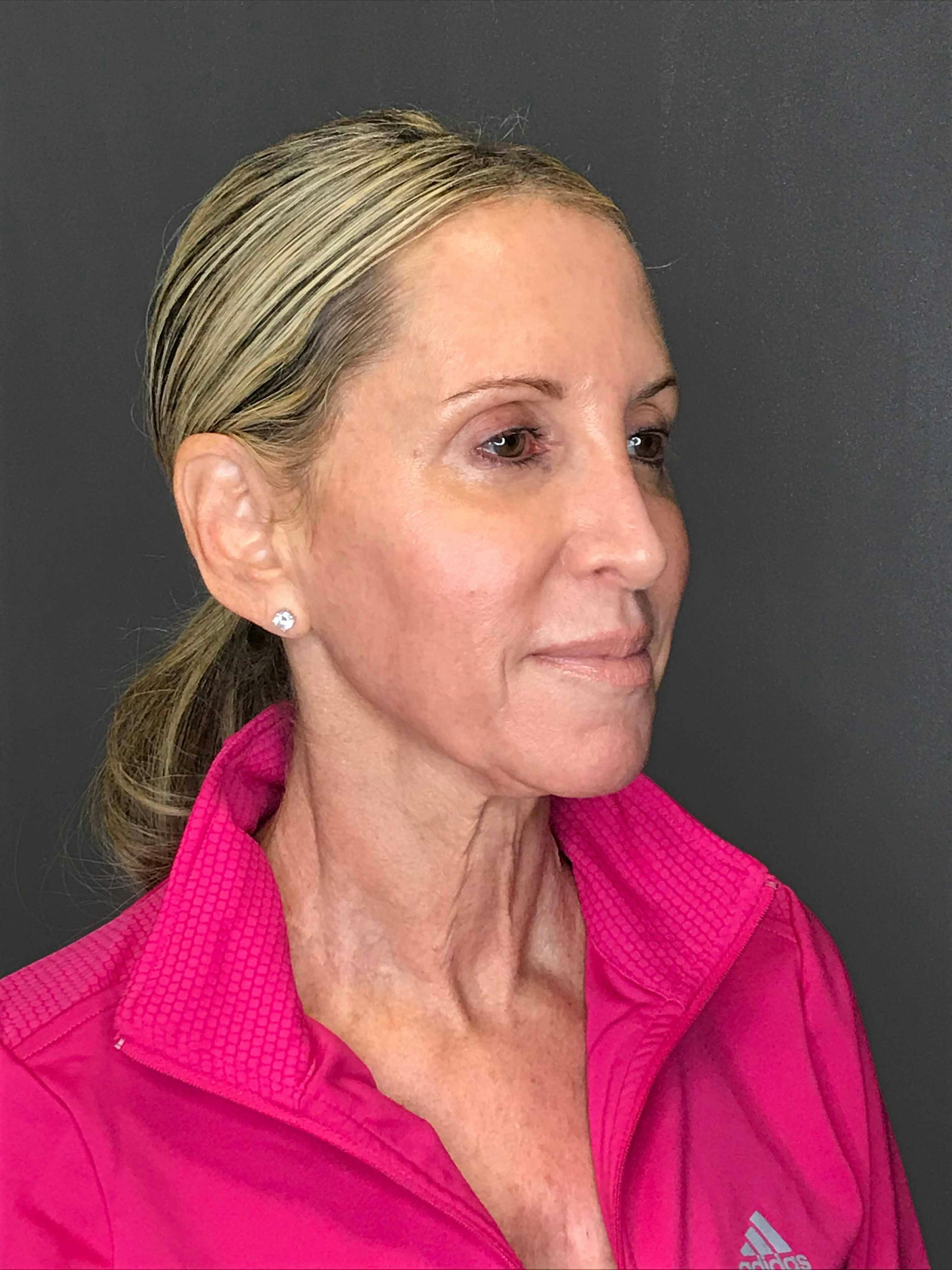 Facelift & Necklift before in NYC right profile view p#1