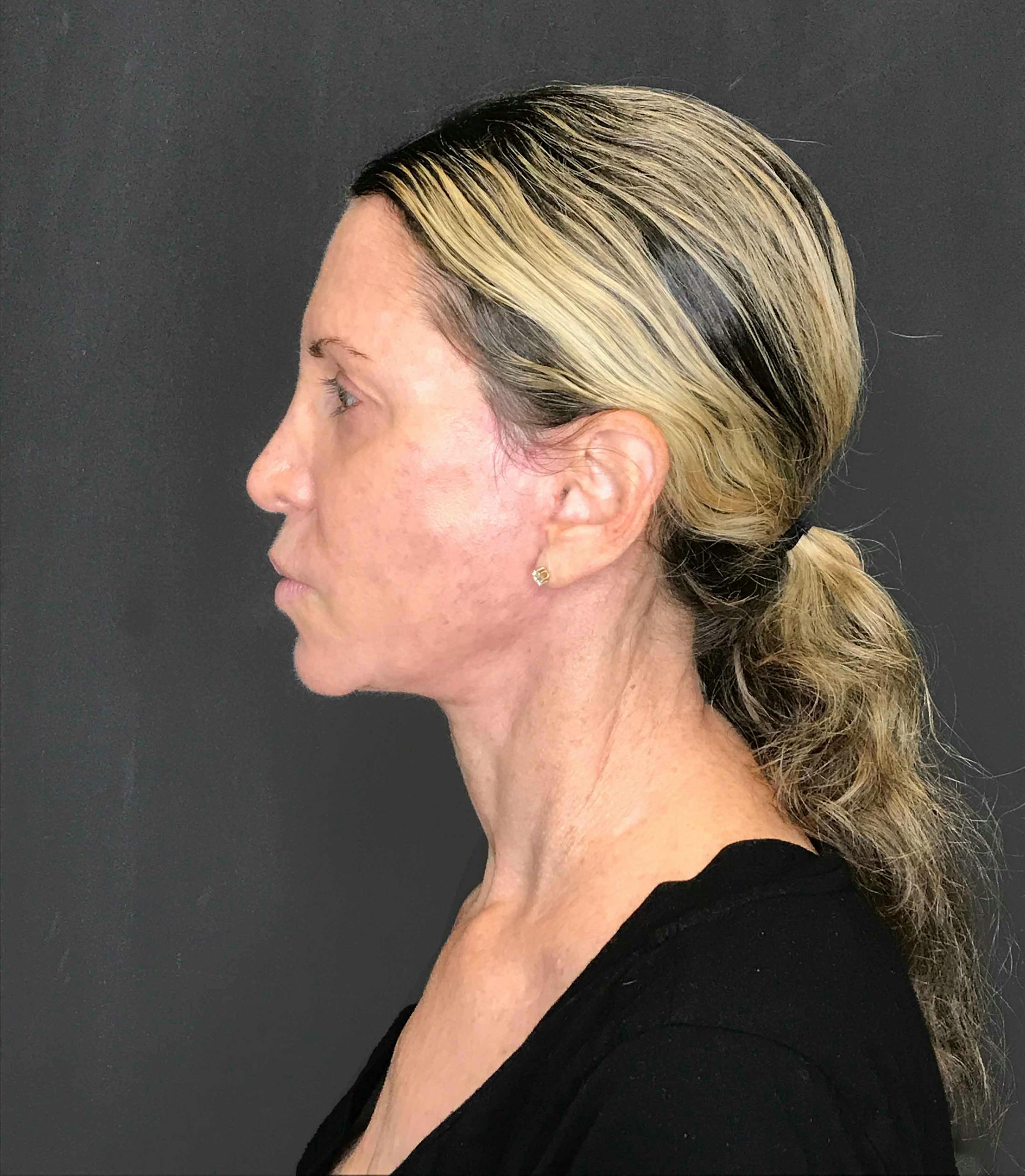 Facelift & Necklift after in NYC left side view p#1