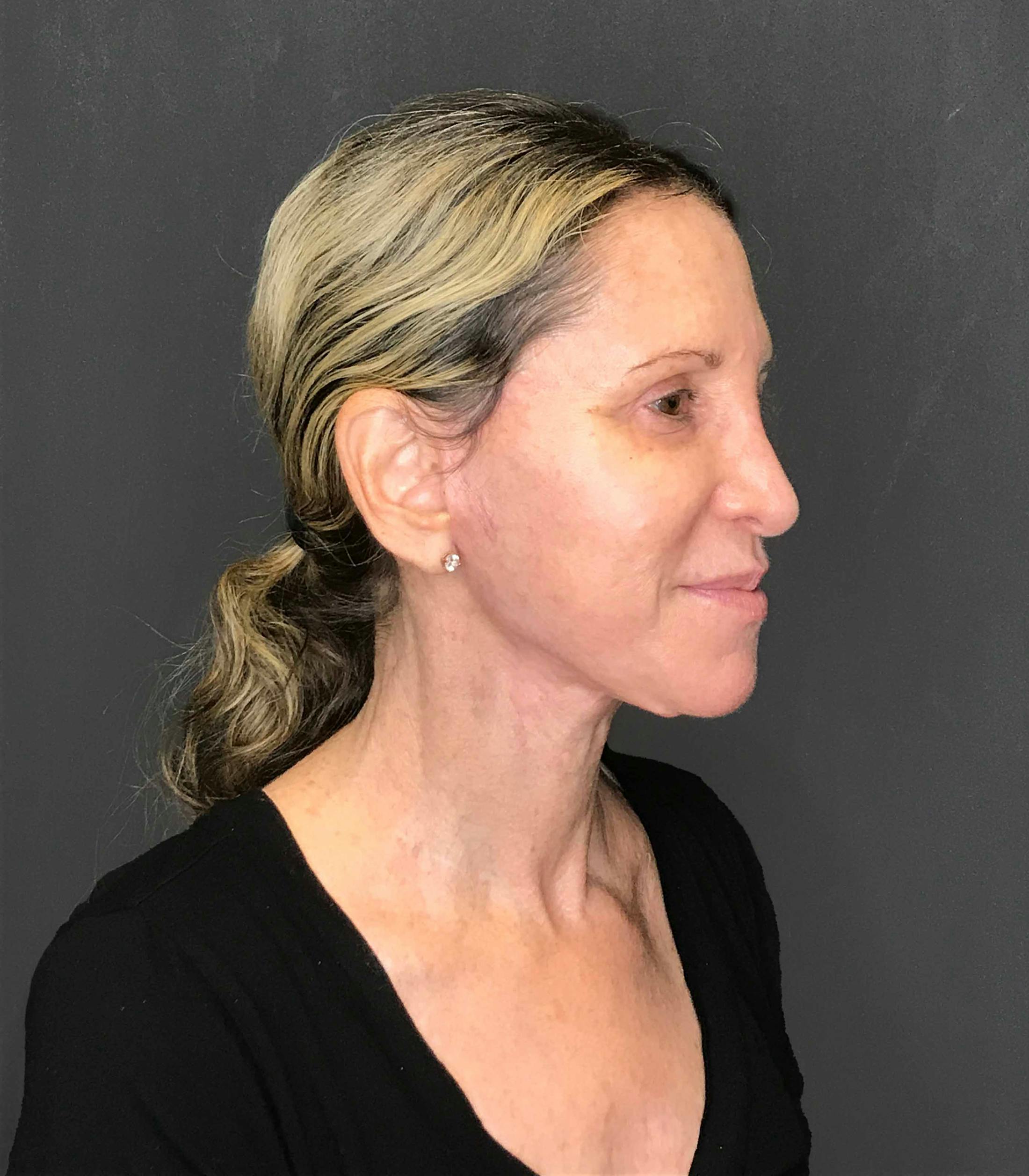 Facelift & Necklift after in NYC right profile view p#1