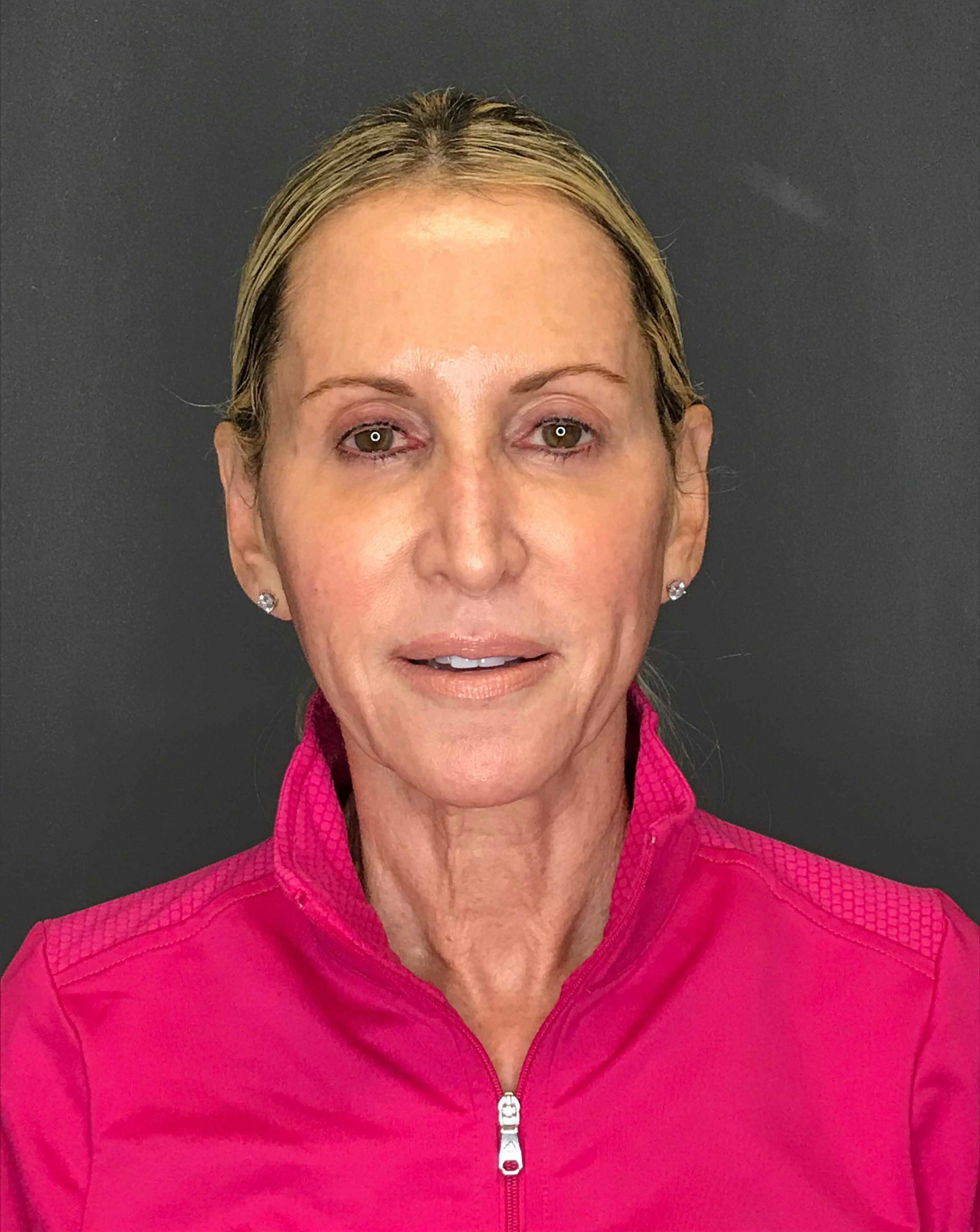 Facelift / Necklift Before & After Gallery - Patient 175934147 - Image 1